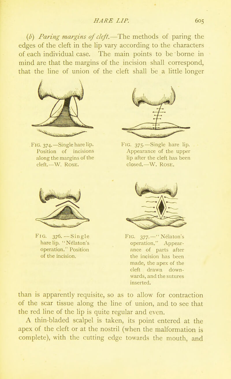 ip) Paring margins of cleft.—The methods of paring the edges of the cleft in the Up vary according to the characters of each individual case. The main points to be borne in mind are that the margins of the incision shall correspond, that the line of union of the cleft shall be a little longer than is apparently requisite, so as to allow for contraction of the scar tissue along the line of union, and to see that the red line of the lip is quite regular and even. A thin-bladed scalpel is taken, its point entered at the apex of the cleft or at the nostril (when the malformation is complete), with the cutting edge towards the mouth, and Fig. 374.—Single harelip. Position of incisions along the margins of the cleft.—W. Rose. Fig. 375.—Single hare lip. Appearance of the upper lip after the cleft has been closed.—W. Rose. Fig. 376.—Single hare lip. '' N^laton's operation. Position of the incision. Fig. 377. —  Nelaton's operation. Appear- ance of parts after the incision has been made, the apex of the cleft drawn down- wards, and the sutures inserted.