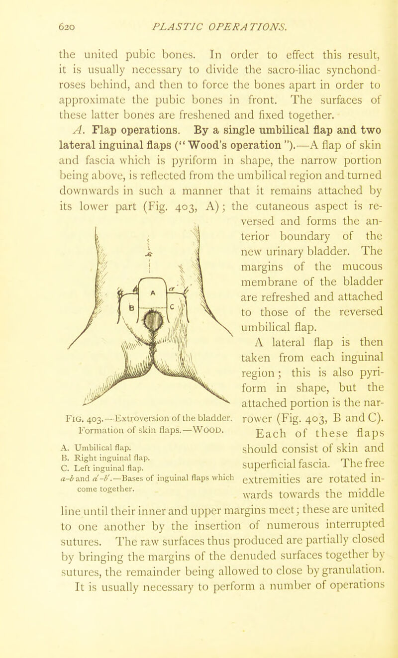 the united pubic bones. In order to effect this result, it is usually necessary to divide the sacro-iliac synchond- roses behind, and then to force the bones apart in order to approximate the pubic bones in front. The surfaces of these latter bones are freshened and fixed together. A. Flap operations. By a single umbilical flap and two lateral inguinal flaps (Wood's operation ).—A flap of skin and fascia which is pyrifonn in shape, the narrow portion being above, is reflected from the umbilical region and turned downwards in such a manner that it remains attached by its lower part (Fig. 403, A); the cutaneous aspect is re- versed and forms the an- terior boundary of the new urinary bladder. The margins of the mucous membrane of the bladder are refreshed and attached to those of the reversed umbilical flap. A lateral flap is then taken from each inguinal region; this is also pyri- form in shape, but the attached portion is the nar- rower (Fig. 403, B and C). Each of these flaps should consist of skin and superficial fascia. The free extremities are rotated in- wards towards the middle line until their inner and upper margins meet; these are united to one another by the insertion of numerous interrupted sutures. The raw surfaces thus produced are partially closed by bringing the margins of the denuded surfaces together by sutures, the remainder being allowed to close by granulation. It is usually necessary to perform a number of operations Fig. 403.—Extroversion of the bladder. Formation of skin flaps.—Wood. A. Umbilical flap. B. Right inguinal flap. C. Left inguinal flap. a-b and d-U.—Bases of inguinal flaps which come together.