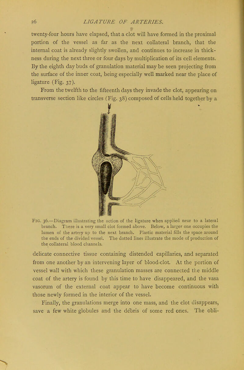 twenty-four hours have elapsed, that a clot will have formed in the proximal portion of the vessel as far as the next collateral branch, that the internal coat is already slightly swollen, and continues to increase in thick- ness during the next three or four days by multiplication of its cell elements. By the eighth day buds of granulation material maybe seen projecting from the surface of the inner coat, being especially well marked near the place of ligature (Fig. 37). From the twelfth to the fifteenth days they invade the clot, appearing on transverse section like circles (Fig. 38) composed of cells held together by a Fig. 36.—Diagram illustrating the action of the ligature when applied near to a lateral branch. There is a very small clot formed above. Below, a larger one occupies the lumen of the artery up to the next branch. Plastic material fills the space around the ends of the divided vessel. The dotted lines illustrate the mode of production of the collateral blood channels. delicate connective tissue containing distended capillaries, and separated from one another by an intervening layer of blood-clot. At the portion of vessel wall with which these granulation masses are connected the middle coat of the artery is found by this time to have disappeared, and the vasa vasorum of the external coat appear to have become continuous with those newly formed in the interior of the vessel. Finally, the granulations merge into one mass, and the clot disappears, save a few white globules and the de'bris of some red ones. The obli-