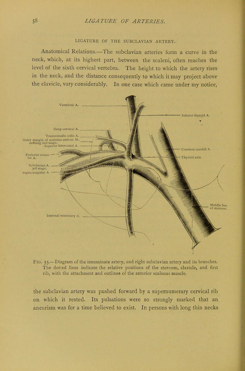 LIGATURE OF THE SUBCLAVIAN ARTERY. Anatomical Relations.—The subclavian arteries form a curve in the neck, which, at its highest part, between the scaleni, often reaches the level of the sixth cervical vertebra. The height to which the artery rises in the neck, and the distance consequently to which it may project above the clavicle, vary considerably. In one case which came under my notice. Fig. 55.—Diagram of the innominate artery, and right subclavian artery and its branches. The dotted lines indicate the relative positions of the sternum, clavicle, and first rib, with the attachment and outlines of the anterior scalenus muscle. the subclavian artery was pushed forward by a supernumerary cervical rib on which it rested. Its pulsations were so strongly marked that an aneurism was for a time believed to exist. In persons with long thin necks