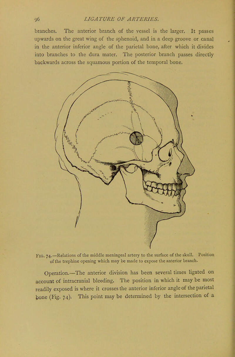 branches. The anterior branch of the vessel is the larger. It passes upwards on the great wing of the sphenoid, and in a deep groove or canal in the anterior inferior angle of the parietal bone, after which it divides into branches to the dura mater. The posterior branch passes directly backwards across the squamous portion of the temporal bone. Fig. 74.—Relations of the middle meningeal artery to the surface of the skull. Position of the trephine opening which may be made to expose the anterior branch. Operation.—The anterior division has been several times ligated on account of intracranial bleeding. The position in which it may be most readily exposed is where it crosses the anterior inferior angle of the parietal bone (Fig. 74). This point may be determined by the intersection of a