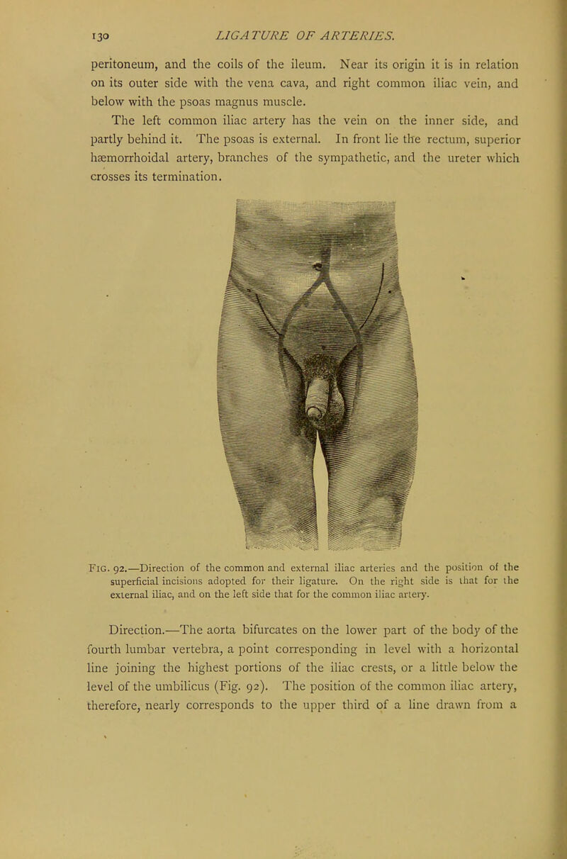 peritoneum, and the coils of the ileum. Near its origin it is in relation on its outer side with the vena cava, and right common iliac vein, and below with the psoas magnus muscle. The left common iliac artery has the vein on the inner side, and partly behind it. The psoas is external. In front lie the rectum, superior hsemorrhoidal artery, branches of the sympathetic, and the ureter which crosses its termination. Fig. 92.—Direction of the common and external iliac arteries and the position of the superficial incisions adopted for tlieir ligature. On the right side is that for the external iliac, and on the left side that for the common iliac artery. Direction.—The aorta bifurcates on the lower part of the body of the fourth lumbar vertebra, a point corresponding in level with a horizontal line joining the highest portions of the iliac crests, or a litde below the level of the umbilicus (Fig. 92). The position of the common iliac artery, therefore, nearly corresponds to the upper third of a line drawn from a