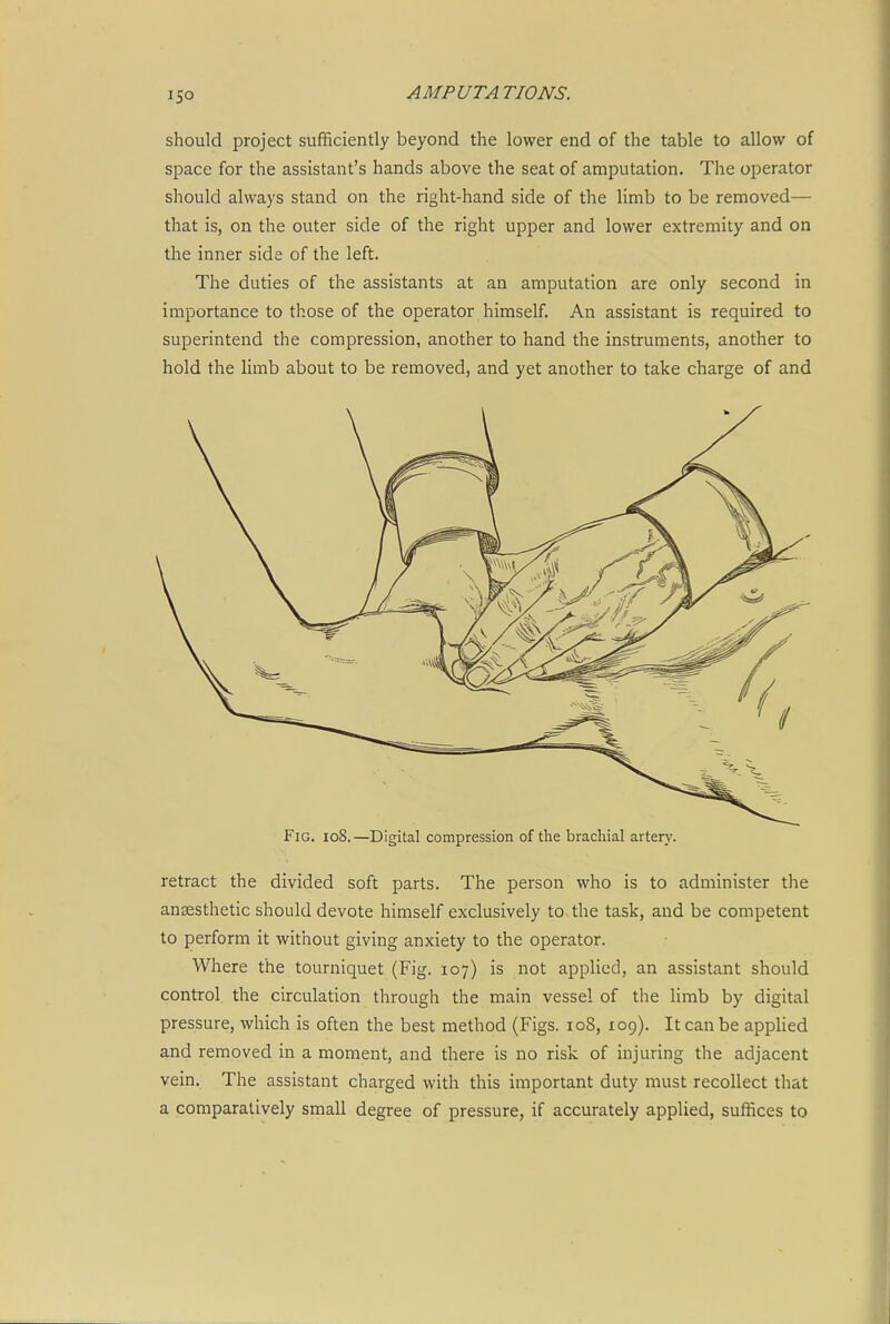 should project sufficiently beyond the lower end of the table to allow of space for the assistant's hands above the seat of amputation. The operator should always stand on the right-hand side of the limb to be removed— that is, on the outer side of the right upper and lower extremity and on the inner side of the left. The duties of the assistants at an amputation are only second in importance to those of the operator himself. An assistant is required to superintend the compression, another to hand the instruments, another to hold the limb about to be removed, and yet another to take charge of and Fig. io8.—Digital compression of the brachial artery. retract the divided soft parts. The person who is to administer the anaesthetic should devote himself exclusively to the task, and be competent to perform it without giving anxiety to the operator. Where the tourniquet (Fig. 107) is not applied, an assistant should control the circulation through the main vessel of the limb by digital pressure, which is often the best method (Figs. 108, 109). It can be applied and removed in a moment, and there is no risk of injuring the adjacent vein. The assistant charged with this important duty must recollect that a comparatively small degree of pressure, if accurately applied, suffices to