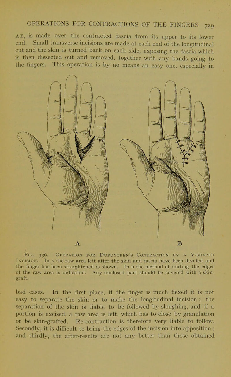 AB, is made over the contracted fascia from its upper to its lower end. Small transverse incisions are made at each end of the longitudinal cut and the skin is turned back on each side, exposing the fascia which is then dissected out and removed, together with any bands going to the fingers. This operation is by no means an easy one, especially in A B Fig. 336. Operation for Dupuytren's Contraction by a V-shaped Incision. In a the raw area left after the skin and fascia have been divided and the finger has been straightened is shown. In b the method of uniting the edges of the raw area is indicated. Any unclosed part should be covered with a skin- graft. bad cases. In the first place, if the finger is much flexed it is not easy to separate the skin or to make the longitudinal incision ; the separation of the skin is liable to be followed by sloughing, and if a portion is excised, a raw area is left, which has to close by granulation or be skin-grafted. Re-contraction is therefore very liable to follow. Secondly, it is difficult to bring the edges of the incision into apposition ; and thirdly, the after-results are not any better than those obtained