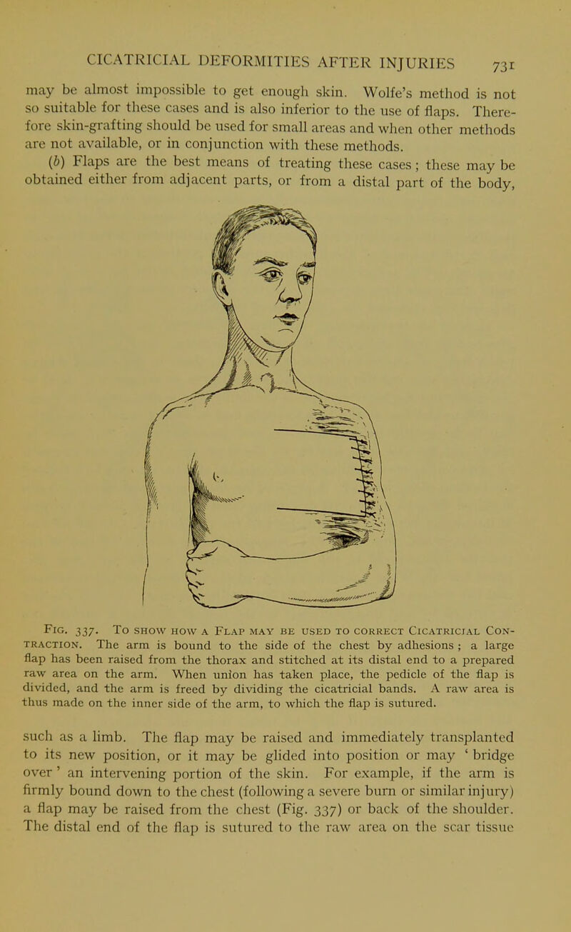 may be almost impossible to get enough skin. Wolfe's method is not so suitable for these cases and is also inferior to the use of flaps. There- fore skin-grafting should be used for small areas and when other methods are not available, or in conjunction with these methods. {b) Flaps are the best means of treating these cases; these may be obtained either from adjacent parts, or from a distal part of the body, Fig. 337. To show how a Flap may be used to correct Cicatricial Con- traction. The arm is bound to the side of the chest by adhesions ; a large flap has been raised from the thorax and stitched at its distal end to a prepared raw area on the arm. When union has taken place, the pedicle of the flap is divided, and the arm is freed by dividing the cicatricial bands. A raw area is thus made on the inner side of the arm, to which the flap is sutured. such as a limb. The flap may be raised and immediately transplanted to its new position, or it may be glided into position or may ' bridge over' an intervening portion of the skin. For example, if the arm is firmly bound down to the chest (following a severe burn or similar injury) a flap may be raised from the chest (Fig. 337) or back of the shoulder. The distal end of the flap is sutured to the raw area on the scar tissue