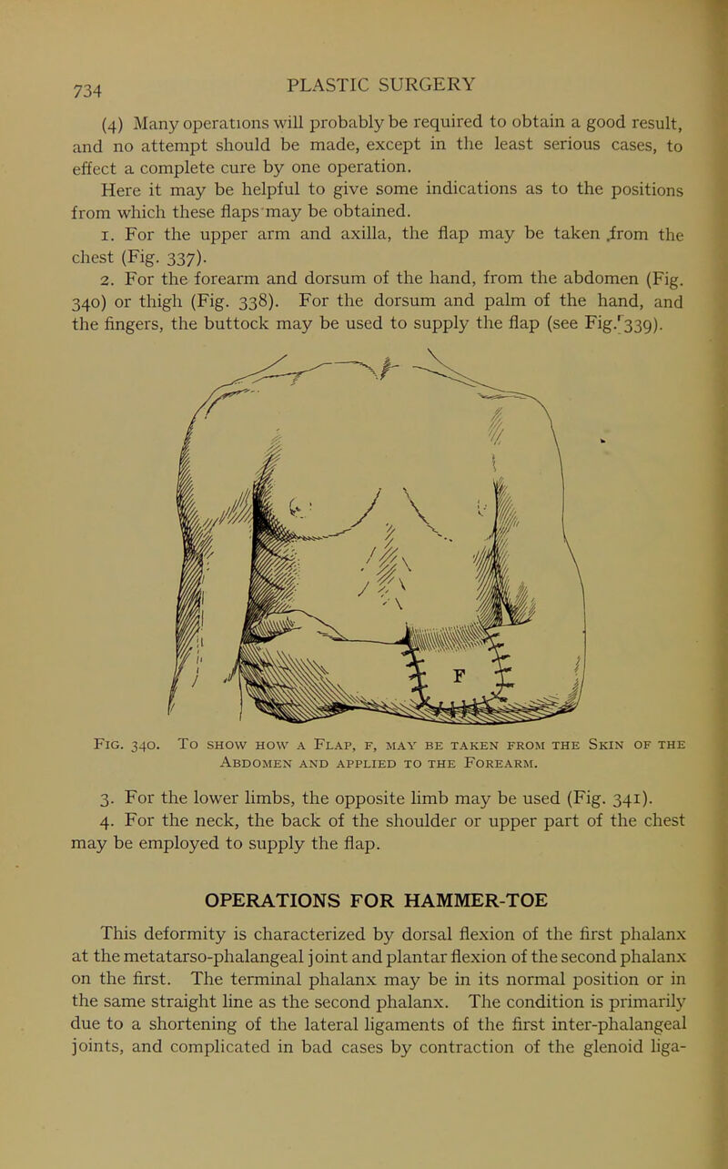 (4) Many operations will probably be required to obtain a good result, and no attempt should be made, except in the least serious cases, to effect a complete cure by one operation. Here it may be helpful to give some indications as to the positions from which these flaps may be obtained. 1. For the upper arm and axilla, the flap may be taken ^rom the chest (Fig. 337). 2. For the forearm and dorsum of the hand, from the abdomen (Fig. 340) or thigh (Fig. 338). For the dorsum and palm of the hand, and the fingers, the buttock may be used to supply the flap (see Fig.^339). Fig. 340. To show how a Flap, f, may be taken from the Skin of the Abdomen and applied to the Forearm. 3. For the lower limbs, the opposite limb may be used (Fig. 341). 4. For the neck, the back of the shoulder or upper part of the chest may be employed to supply the flap. OPERATIONS FOR HAMMER-TOE This deformity is characterized by dorsal flexion of the first phalanx at the metatarso-phalangeal joint and plantar flexion of the second phalanx on the first. The terminal phalanx may be in its normal position or in the same straight line as the second phalanx. The condition is primarily due to a shortening of the lateral ligaments of the first inter-phalangeal joints, and complicated in bad cases by contraction of the glenoid liga-