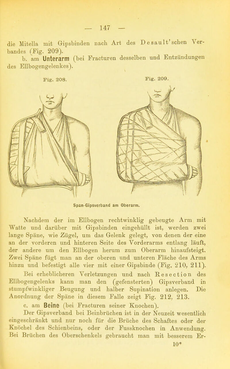 die Mitella mit Gipsbinden nach Art des D e sault'sehen Ver- bandes (Fig. 209). b. am Unterarm (bei Fracturen desselben und Entzündungen des Ellbogengelenkes). Fig. 208. Fig- 209. Span-Gipsverband am Oberarm. Nachdem der im Ellbogen rechtwinklig gebeugte Arm mit Watte und darüber mit Gipsbinden eingehüllt ist, werden zwei lange Späne, wie Zügel, um das Gelenk gelegt, von denen der eine an der vorderen und hinteren Seite des Vorderarms entlang läuft, der andere um den Ellbogen herum zum Oberarm hinaufsteigt. Zwei Späne fügt man an der oberen und unteren Fläche des Arms hinzu und befestigt alle vier mit einer Gipsbinde (Fig. 210, 211). Bei erheblicheren Verletzungen und nach Resection des Ellbogengelenks kann man den (gefensterten) Gipsverband in stumpfwinkliger Beugung und halber Supination anlegen. Die Anordnung der Späne in diesem Falle zeigt Fig. 212, 213. c. am Beine (bei Fracturen seiner Knochen). Der Gipsverband bei Beinbrüchen ist in der Neuzeit wesentlich eingeschränkt und nur noch für die Brüche des Schaftes oder der Knöchel des Schienbeins, oder der Fussknochen in Anwendung. Bei Brüchen des Oberschenkels gebraucht man mit besserem Er- 10*