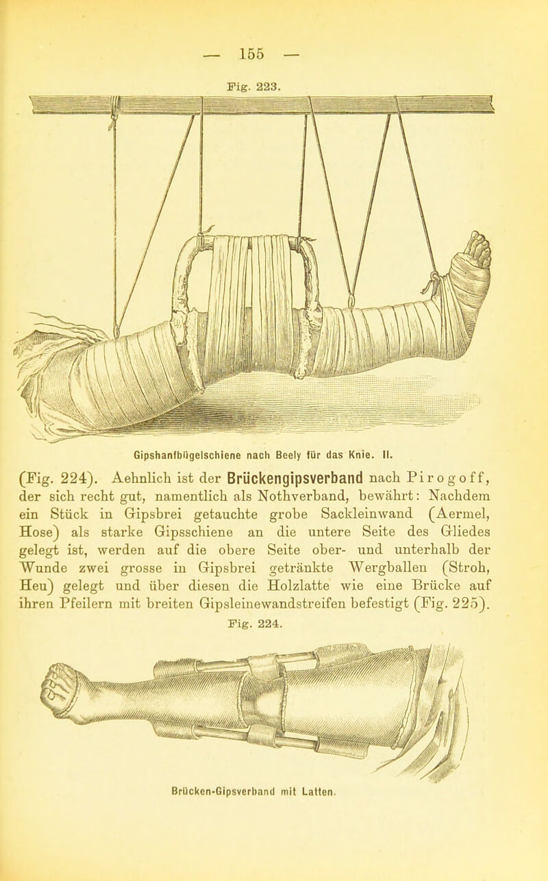 Fig. 223. Gipshanfbiigelschiene nach Beely für das Knie. II. (Fig. 224). Aehnlich ist der Brückengipsverband nach Pirogoff, der sich recht gut, namentlich als Nothverband, bewährt: Nachdem ein Stück in Gipsbrei getauchte grobe Sackleinwand (Aermel, Hose) als starke Gipsschiene an die untere Seite des Gliedes gelegt ist, werden auf die obere Seite ober- und unterhalb der Wunde zwei grosse in Gipsbrei getränkte Wergballen (Stroh, Heu) gelegt und über diesen die Holzlatte wie eine Brücke auf ihren Pfeilern mit breiten Gipsleinewandstreifen befestigt (Fig. 225). Fig. 224. Brücken-Gipsverband mit Latten.