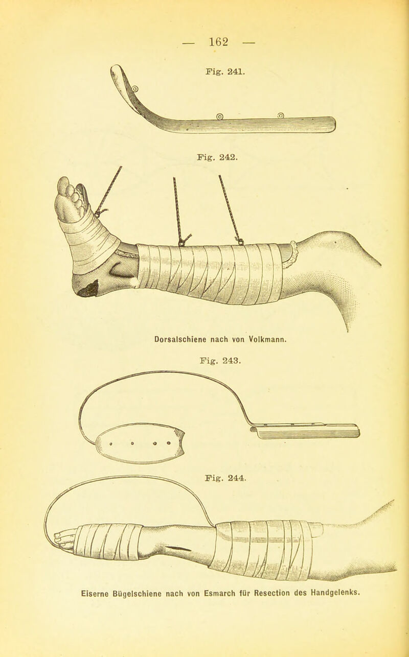 Dorsalschiene nach von Volkmann. Fig. 243.
