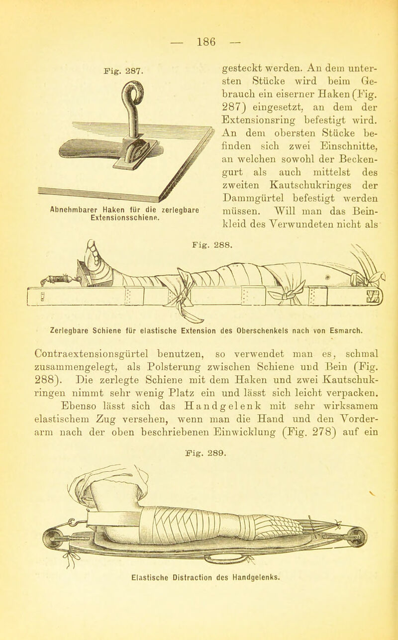 Fig. 287. Abnehmbarer Haken für die zerlegbare Extensionsschiene. gesteckt werden. Au dein unter- sten Stücke wird beim Ge- brauch ein eiserner Haken (Fig. 287) eingesetzt, an dem der Extensionsring befestigt wird. An dem obersten Stücke be- finden sich zwei Einschnitte, an welchen sowohl der Becken- gurt als auch mittelst des zweiten Kautschukringes der Dammgürtel befestigt werden müssen. Will man das Bein- kleid des Verwundeten nicht als Fig. 288. i V 1 Zerlegbare Schiene für elastische Extension des Oberschenkels nach von Esmarch. Contraextensionsgürtel benutzen, so verwendet man es, schmal zusammengelegt, als Polsterung zwischen Schiene und Bein (Fig. 288). Die zerlegte Schiene mit dem Haken und zwei Kautschuk- ringen nimmt sehr wenig Platz ein und lässt sich leicht verpacken. Ebenso lässt sich das Handgelenk mit sehr wirksamem elastischem Zug versehen, wenn man die Hand und den Vorder- arm nach der oben beschriebenen Einwicklung (Fig. 278) auf ein Fig. 289. Elastische Distraction des Handgelenks.
