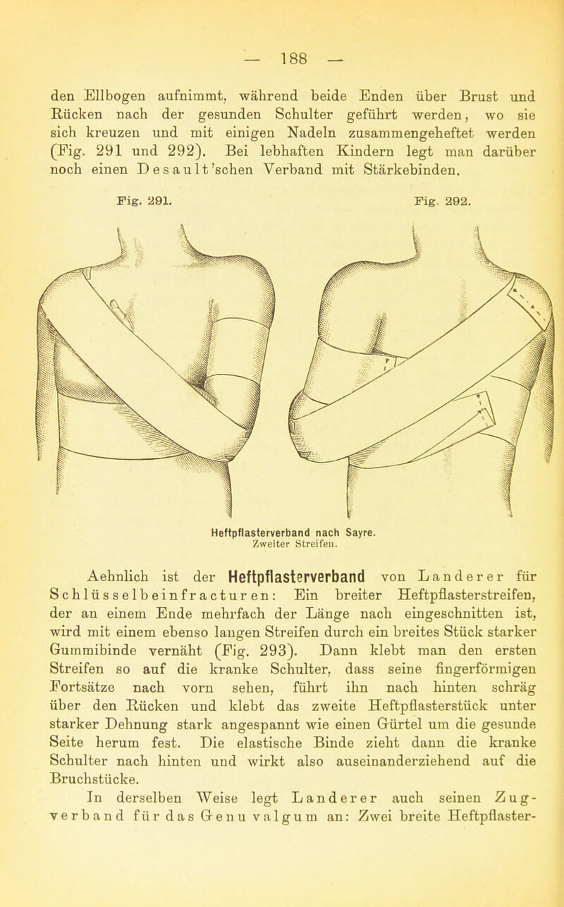 den Ellbogen aufnimmt, während beide Enden über Brust und Rücken nach der gesunden Schulter geführt werden, wo sie sich kreuzen und mit einigen Nadeln zusammengeheftet werden (Fig. 291 und 292). Bei lebhaften Kindern legt man darüber noch einen D e s a u 11 'sehen Verband mit Stärkebinden. Fig. 291. Fig. 292. Heftpflasterverhand nach Sayre. Zweiter Streifen. Aehnlich ist der Heftpflasterverband von Lander er für Schlüsselbeinfracturen: Ein breiter Heftpflasterstreifeu, der an einem Ende mehrfach der Länge nach eingeschnitten ist, wird mit einem ebenso langen Streifen durch ein breites Stück starker Gummibinde vernäht (Pig. 293). Dann klebt man den ersten Streifen so auf die kranke Schulter, dass seine fingerförmigen Fortsätze nach vorn sehen, führt ihn nach hinten schräg über den Rücken und klebt das zweite Heftpflasterstück unter starker Dehnung stark angespannt wie einen Gürtel um die gesunde Seite herum fest. Die elastische Binde zieht dann die kranke Schulter nach hinten und wirkt also auseinanderziehend auf die Bruchstücke. In derselben Weise legt Lander er auch seinen Zug- verband für das Genu valgum an: Zwei breite Heftpflaster-