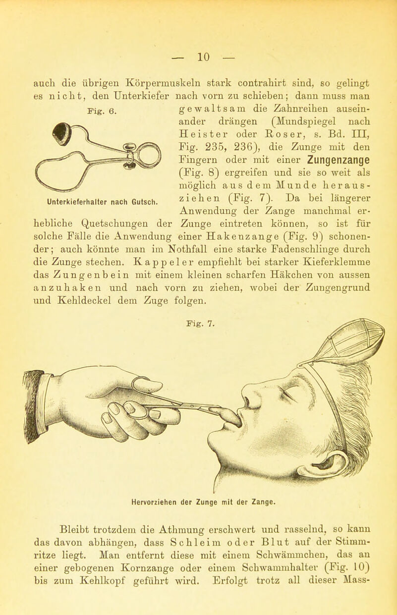 auch die übrigen Körpermuskeln stark contrahirt sind, so gelingt es nicht, den Unterkiefer nach vorn zu schieben; dann muss man Pig. 6. gewaltsam die Zahnreihen ausein- ander drängen (Mundspiegel nach Heister oder ßoser, s. Bd. III, Fig. 235, 236), die Zunge mit den Fingeim oder mit einer Zungenzange (Fig. 8) ergreifen und sie so weit als möglich aus dem Munde heraus- ziehen (Fig. 7). Da bei längerer Anwendung der Zange manchmal er- hebliche Quetschungen der Zunge eintreten können, so ist für solche Fälle die Anwendung einer Hakenzange (Fig. 9) schonen- der; auch könnte man im Nothfall eine starke Fadenschlinge durch die Zunge stechen. Kappeler empfiehlt bei starker Kieferklemme das Zungenbein mit einem kleinen scharfen Häkchen von aussen anzuhaken und nach vorn zu ziehen, wobei der Zungengrund und Kehldeckel dem Zuge folgen. Unterkieferhalter nach Gutsch. Fig. 7 Hervorziehen der Zunge mit der Zange. Bleibt trotzdem die Athmung erschwert und rasselnd, so kann das davon abhängen, dass Schleim oder Blut auf der Stimm- ritze liegt. Man entfernt diese mit einem Schwämmchen, das an einer gebogenen Kornzange oder einem Schwammhalter (Fig. 10) bis zum Kehlkopf geführt wird. Erfolgt trotz all dieser Mass-