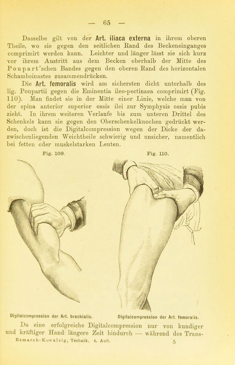 Dasselbe gilt von der Art. iiiaca externa in ihrem oberen Theile, wo sie gegen den seitlichen ßand des Beckeneinganges comprimirt werden kann. Leichter und länger lässt sie sich kurz vor ihrem Austritt aus dem Becken oberhalb der Mitte des P 0 u p a rt'sehen Bandes gegen den oberen Eand des horizontalen Schambeiuastes zusammendrücken. Die Art. femoralis wird am sichersten dicht unterhalb des lig. Poupartii gegen die Eminentia ileo-pectinaea comprimirt (Fig. 110). Man findet sie in der Mitte einer Linie, welche man von der Spina anterior superior ossis ilei zur Symphysis ossis pubis zieht. In ihrem weiteren Verlaufe bis zum unteren Drittel des Schenkels kann sie gegen den Oberschenkelknochen gedrückt wer- den, doch ist die Digitalcompression wegen der Dicke der da- zwischenliegenden Weichtheile schwierig und unsicher, namentlich bei fetten oder muskelstarken Leuten. Fig. 109. Fig. 110. Digitalcompression der Art. bracliialis. Digitalcompression der Art. femoralis. Da eine erfolgreiche Digitalcompression nur von kundiger und krcäftiger Hand längere Zeit hindurch — während des Trans- Ksmaroh-Kuwalziff, Teclinik. i. Aull.