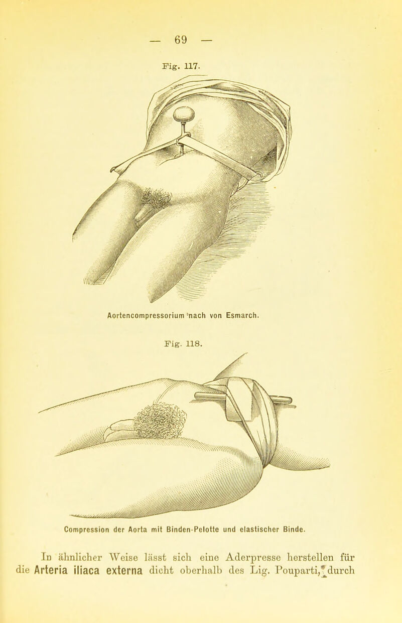 Fig. 117. Aortencompressorium'nach von Esmarch. Fig. 118. Compression der Aorta mit Binden-Pelotte und elastischer Binde. In älinllcher Weise liisst sicli eine Aderpresse lierstellen für Arteria iiiaca externa dicht oberhalb des Lig. Pouparti,'durch