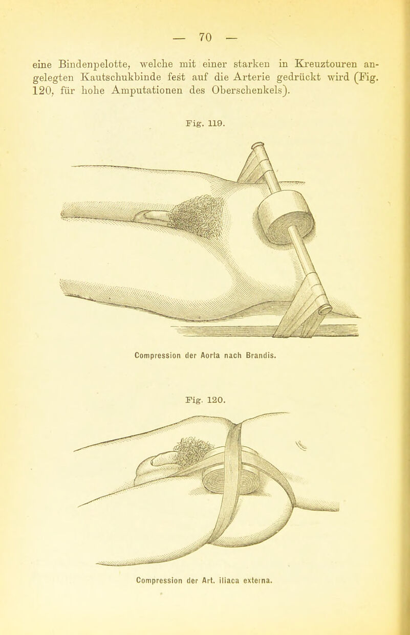 eine Bindenpelotte, welche mit einer starken in Kreuztouren an- gelegten Kautschukbinde fest auf die Arterie gedrückt wird (Fig. 120, für hohe Amputationen des Oberschenkels). Fig. 119. Compression der Aorta nach Brandis. Fig. 120. Compression der Art. iiiaca externa.