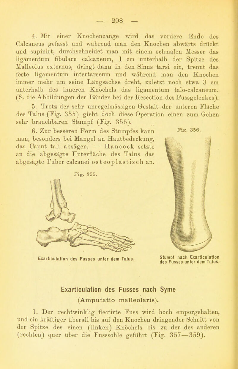 4. Mit einer Knochenzange wird das vordere Ende des Calcaneus gefasst und während man den Knochen abwärts drückt und supinirt, durchschneidet man mit einem schmalen Messer das ligamentum fibulare calcaneum, 1 cm unterhalb der Spitze des Malleolus externus, dringt dann in den Sinus tarsi ein, trennt das feste ligamentum intertarseum und während man den Knochen immer mehr um seine Längsachse dreht, zuletzt noch etwa 3 cm unterhalb des inneren Knöchels das ligamentum talo-calcaneura. (S. die Abbildungen der Bänder bei der ßesectiou des Fussgelenkes). 5. Trotz der sehr unregelmässigen Gestalt der unteren Fläche des Talus (Fig. 355) giebt doch diese Operation einen zum Gehen sehr brauchbaren Stumpf (Fig. 356). 6. Zur besseren Form des Stumpfes kann 356. man, besonders bei Mangel an Hautbedeckung, das Caput tali absägen. — Hancock setzte an die abgesägte TJnterfläche des Talus das abgesägte Tuber calcanei osteoplastisch an. Fig. 355. Exarticulation des Fusses unter dem Talus. Stumpf nach Exarticulation des Fusses unter dem Talus. Exarticulation des Fusses nach Syme (Amputatio malleolaris). 1. Der rechtwinklig flectirte Fuss wird hoch emporgehalten, und ein kräftiger überall bis auf den Knochen dringender Schnitt von der Spitze des einen (linken) Knöchels bis zu der des anderen (rechten) quer über die Fusssohle geführt (Fig. 357—359).