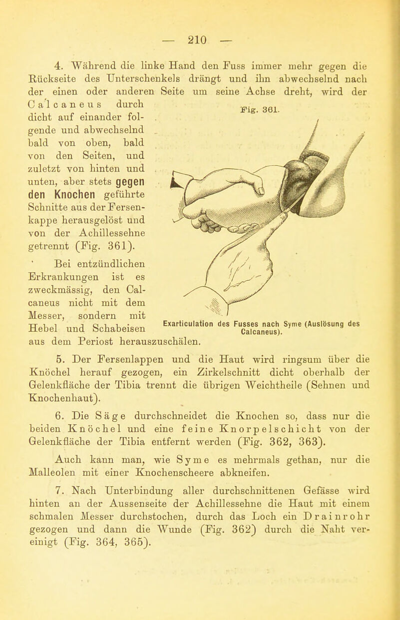 Fig. 361. 4. Während die linke Hand den Fuss immer mehr gegen die Rückseite des Unterschenkels drängt und ihn abwechselnd nach der einen oder anderen Seite um seine Achse dreht, wird der Calcaneus durch dicht auf einander fol- gende und abwechselnd bald von oben, bald von den Seiten, und zuletzt von hinten und unten, aber stets QGQGn den Knochen geführte Schnitte aus der Fersen- kappe herausgelöst und von der Achillessehne getrennt (Fig. 361). Bei entzündlichen Erkrankungen ist es zweckmässig, den Cal- caneus nicht mit dem Messer, sondern mit Hebel und Schabeisen Exarticulaiion des Fusses nach Syme (Auslbsung des Calcaneus). aus dem Periost herauszuschälen. 5. Der Fersenlappen und die Haut wird ringsum über die Knöchel herauf gezogen, ein Zirkelschnitt dicht oberhalb der Gelenkfläche der Tibia trennt die übrigen Weichtheile (Sehnen und Knochenhaut). 6. Die Säge durchschneidet die Knochen so, dass nur die beiden Knöchel und eine feine Knorpelschicht von der Gelenkfläche der Tibia entfernt werden (Fig. 362, 363). Auch kann man, wie Syme es mehrmals gethan, nur die Malleolen mit einer Knochenscheere abkneifen. 7. Nach Unterbindung aller durchschnittenen Gefässe wird hinten an der Aussenseite der Achillessehne die Haut mit einem schmalen Messer durchstochen, durch das Loch ein Drainrohr gezogen und dann die Wunde (Fig. 362) durch die Naht ver- einigt (Fig. 364, 365).