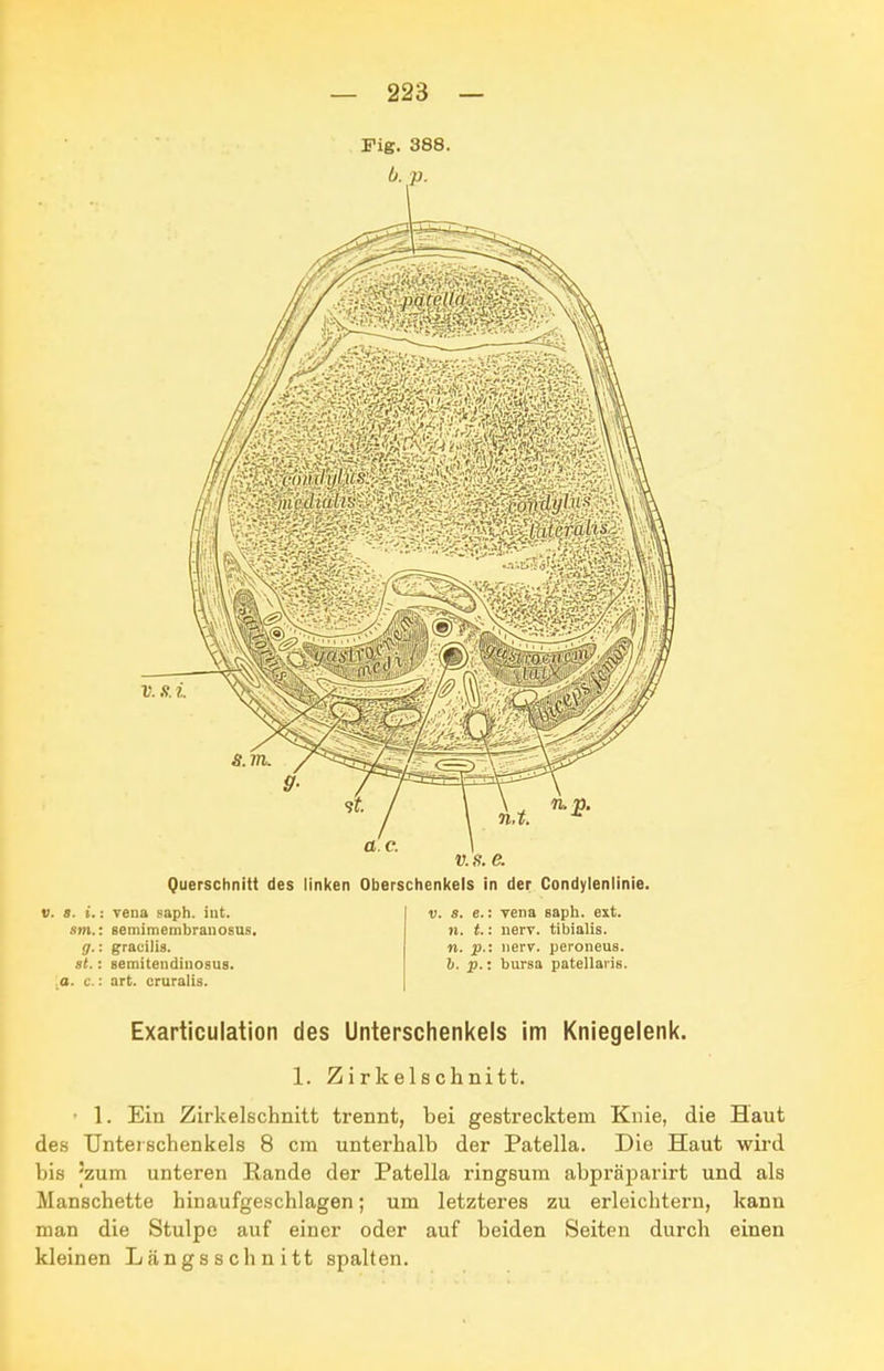 v.s. e. Querschnitt des linken Oberschenkels in der Condylenlinie. . s. i.: Vena saph. iut. sm.: aemimembranosus. g.: graeilis. st.: semitendinosus. a. c.: art. cruralis. V. 3. e. n. t. n. p. b. p. yena Baph. ext. nerv, tibialis. nerv, peroneus, bursa patellaris. Exarticulation des Unterschenkels im Kniegelenk. 1. Zirkelschnitt. • 1. Ein Zirkelschnitt trennt, bei gestrecktem Knie, die Haut des Unterschenkels 8 cm unterhalb der Patella. Die Haut wird bis 'zum unteren Rande der Patella ringsum abpräparirt und als Manschette hinaufgeschlagen; um letzteres zu erleichtern, kann man die Stulpe auf einer oder auf beiden Seiten kleinen Längsschnitt spalten. durch einen