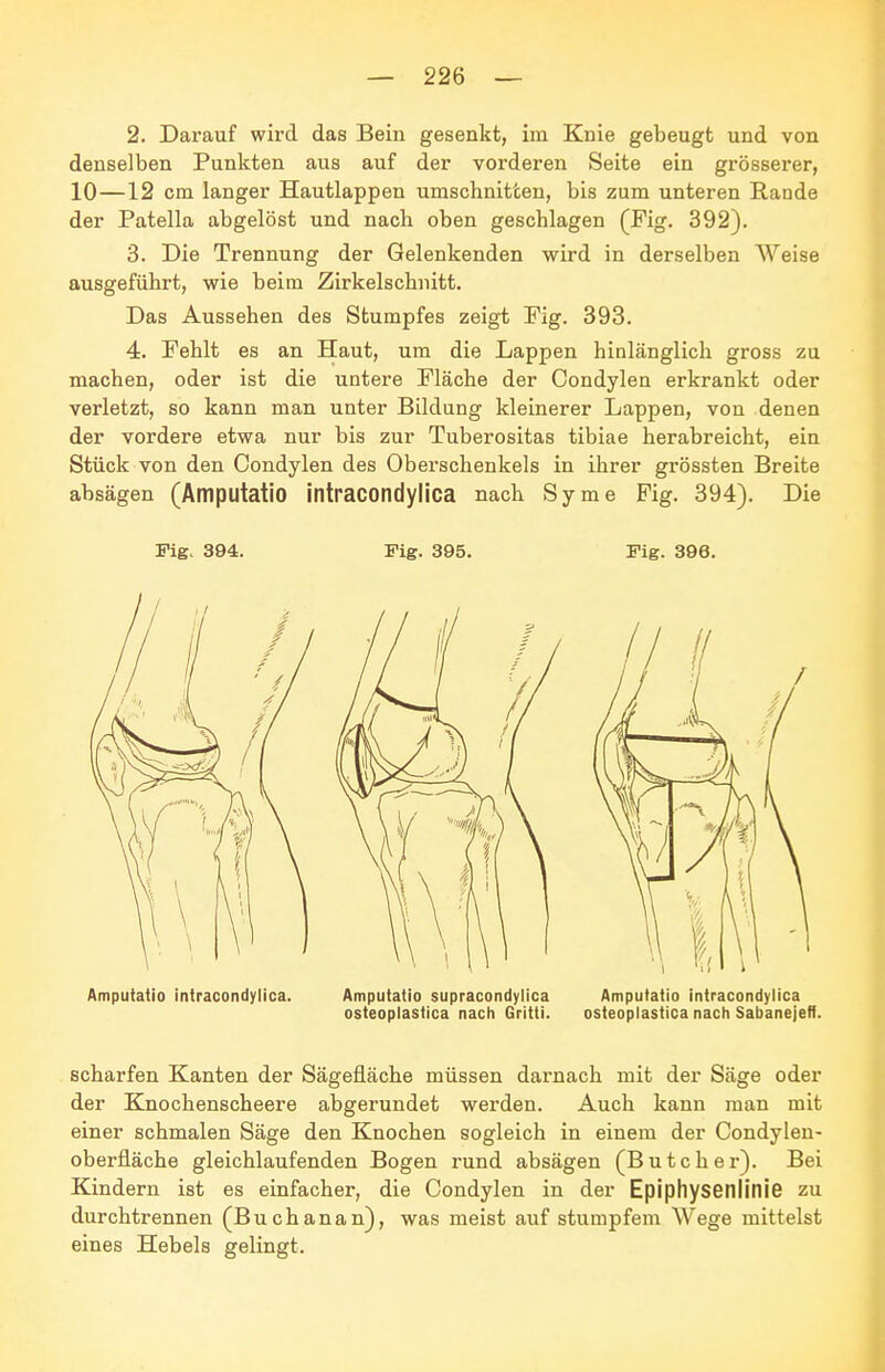 2. Darauf wird das Bein gesenkt, im Knie gebeugt und von denselben Punkten aus auf der vorderen Seite ein grösserer, 10—12 cm langer Hautlappen umschnitten, bis zum unteren Rande der Patella abgelöst und nach oben geschlagen (Fig. 392). 3. Die Trennung der Gelenkenden wird in derselben Weise ausgeführt, wie beim Zirkelschnitt. Das Aussehen des Stumpfes zeigt Fig. 393. 4. Fehlt es an Haut, um die Lappen hinlänglich gross zu machen, oder ist die untere Fläche der Condylen erkrankt oder verletzt, so kann man unter Bildung kleinerer Lappen, von denen der vordere etwa nur bis zur Tuberositas tibiae herabreicht, ein Stück von den Condylen des Oberschenkels in ihrer grössten Breite absägen (Amputatio itltracondylica nach Syme Fig. 394). Die Fig. 394. Fig. 395. Fig. 396. Ampuiaiio intracondylica. Amputatio supracondylica Amputatio intracondylica osteoplastica nach Gritti. osieoplastica nach Sabanejefl. scharfen Kanten der Sägefläche müssen darnach mit der Säge oder der Knochenscheere abgerundet werden. Auch kann man mit einer schmalen Säge den Knochen sogleich in einem der Condylen- oberfläche gleichlaufenden Bogen rund absägen (Butcher). Bei Kindern ist es einfacher, die Condylen in der Epiphysetllitlie zu durchtrennen (Buchanan), was meist auf stumpfem Wege mittelst eines Hebels gelingt.