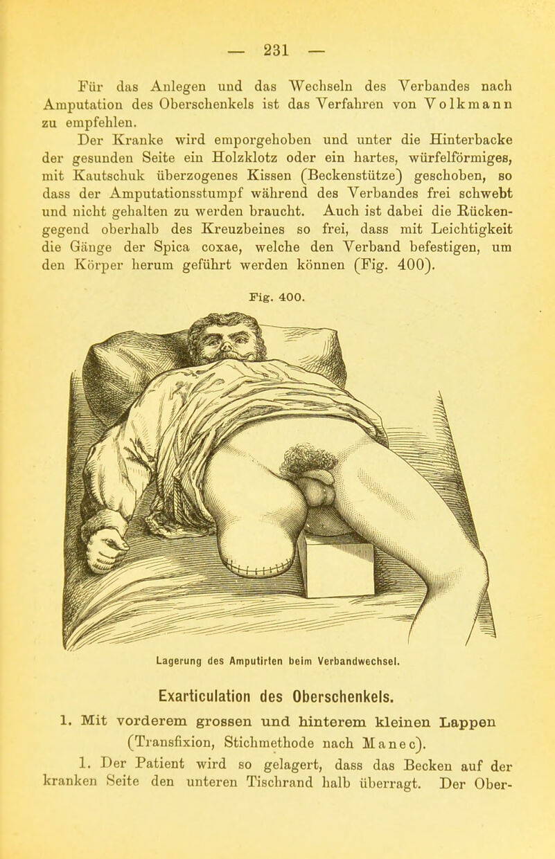 Für das Aulegen und das Wechseln des Verbandes nach Amputation des Oberschenkels ist das Verfahren von Volkmann zu empfehlen. Der Kranke wird emporgehoben und unter die Hinterbacke der gesunden Seite ein Holzklotz oder ein hartes, würfelförmiges, mit Kautschuk überzogenes Kissen (Beckenstütze) geschoben, so dass der Amputationsstumpf während des Verbandes frei schwebt und nicht gehalten zu werden braucht. Auch ist dabei die Rücken- gegend oberhalb des Kreuzbeines so frei, dass mit Leichtigkeit die Gänge der Spica coxae, welche den Verband befestigen, um den Körper herum geführt werden können (Fig. 400). Fig. 400. Lagerung des Amputlrlen beim Verbandwechsel. Exarticulation des Oberschenkels. 1. Mit vorderem grossen und hinterem kleinen Lappen (Transfixion, Stichmethode nach Manec). 1. Der Patient wird so gelagert, dass das Becken auf der kranken Seite den unteren Tischrand halb überragt. Der Ober-