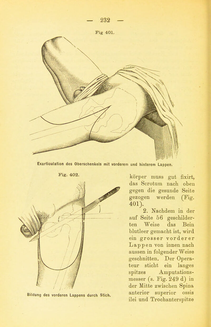 Pig 401. Exarticulation des Oberschenkels mit vorderem und hinlerem Lappen. Fig. 402. Idung des vorderen Lappens durch Stich. körper muss gut fixirt, das Scrotum nach obeu gegen die gesunde Seite gezogen werden (Fig. 401). 2. Nachdem in der auf Seite 56 geschilder- ten Weise das Bein blutleer gemacht ist, wird ein grosser vorderer Lappen von innen nach aussen in folgender Weise geschnitten. Der Opera- teur sticht ein langes spitzes Amputations- messer (s. Fig. 249 d) in der Mitte zwischen Spina anterior superior ossis ilei und Trochanterspitze