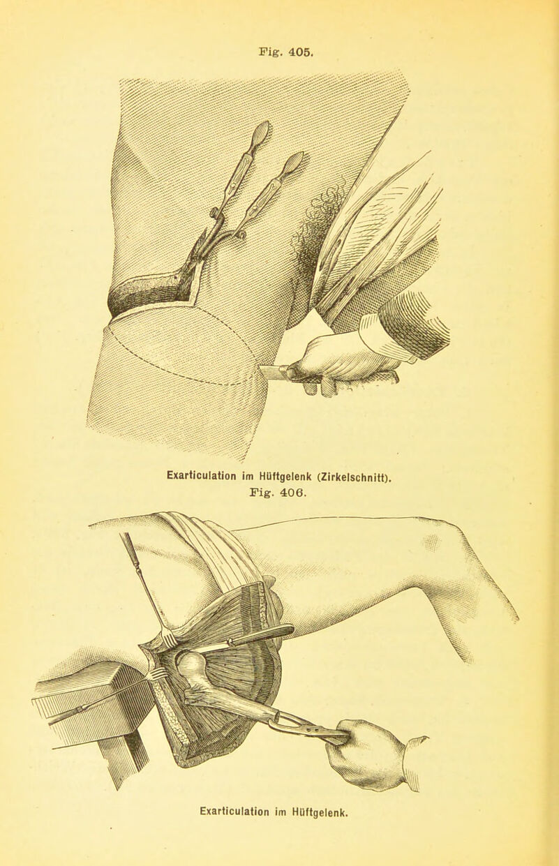 Pig. 405. Exarticulation im Hüftgelenk.
