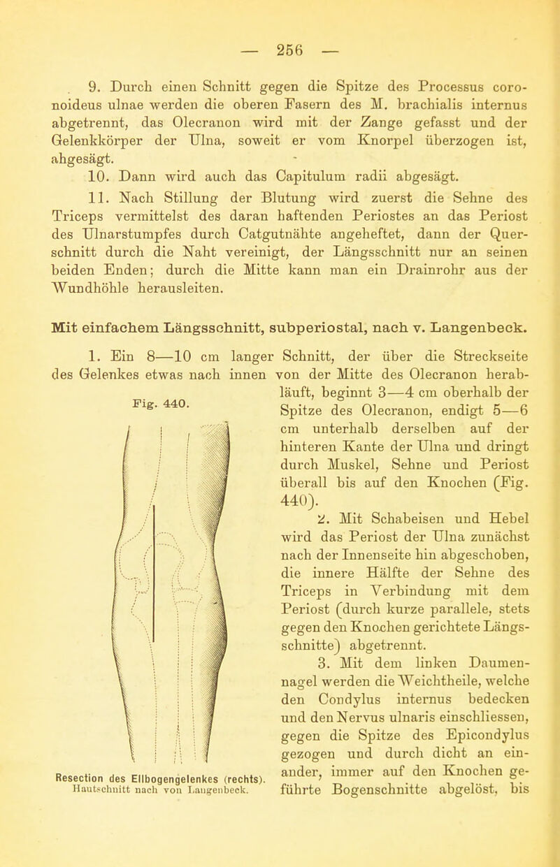 9. Durch einen Schnitt gegen die Spitze des Processus coro- noideus ulnae werden die oberen Fasern des M. brachialis internus abgetrennt, das Olecranon wird mit der Zange gefasst und der Gelenkkörper der TJIna, soweit er vom Knorpel überzogen ist, abgesägt. 10. Dann wird auch das Capitulum radii abgesägt. 11. Nach Stillung der Blutung wird zuerst die Sehne des Triceps vermittelst des daran haftenden Periostes an das Periost des Ulnarstumpfes durch Catgutnähte angeheftet, dann der Quer- schnitt durch die Naht vereinigt, der Längsschnitt nur an seinen beiden Enden; durch die Mitte kann man ein Drainrohr aus der Wundhöhle herausleiten. Mit einfachem Längsschnitt, subperiostal, nach v. Langenbeck. Fig. 440. i I 1. Ein 8—10 cm langer Schnitt, der über die Streckseite des Gelenkes etwas nach innen von der Mitte des Olecranon herab- läuft, beginnt 3—4 cm oberhalb der Spitze des Olecranon, endigt 5—6 cm unterhalb derselben auf der hinteren Kante der Ulna und dringt durch Muskel, Sehne und Periost überall bis auf den Knochen (Eig. 440). 2. Mit Schabeisen und Hebel wird das Periost der TJlna zunächst nach der Innenseite hin abgeschoben, die innere Hälfte der Sehne des Triceps in Verbindung mit dem Periost (durch kurze parallele, stets gegen den Knochen gerichtete Längs- schnitte) abgetrennt. 3. Mit dem linken Daumen- nagel werden die AVeichtheile, welche den Condylus internus bedecken und den Nervus ulnaris einschliesseu, gegen die Spitze des Epicondylus gezogen und durch dicht an ein- p..o„»!„_ j ciiu ' • • , 1.1, ander, immer auf den Knochen ge- Resection des Ellbogengelenkes (rechts). ' , . Hautschnitt nach Ton i.anjjeiibcck. führte Bogenschnitte abgelöst, bis