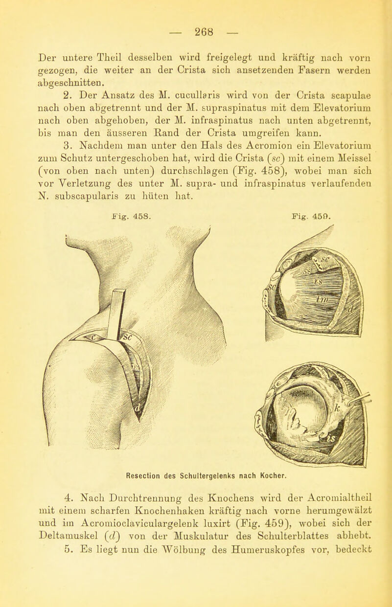 Der untere Thcil desselben wird freigelegt und kräftig nach vorn gezogen, die weiter an der Crista sich ansetzenden Fasern werden abgeschnitten. 2. Der Ansatz des M. cucullaris wird von der Crista scapulae nach oben abgetrennt und der M. &upraspinatus mit dem Elevatorium nach oben abgehoben, der M. infraspinatus nach unten abgetrennt, bis man den äusseren Rand der Crista umgreifen kann. 3. Nachdem mau unter den Hals des Acromion ein Elevatorium zum Schutz untergeschoben hat, wird die Crista (sc) mit einem Meissel (von oben nach unten) durchschlagen (Fig. 458), wobei man sich vor Verletzung des unter M. supra- und infraspinatus verlaufenden N. subscapularis zu hüten hat. Fig. 458. Fig. 450. Resection des Schultergelenks nach Kocher. 4. Nach Durchtreunung des Knochens wird der Acroniialtheil mit einem scharfen Knochenhaken kräftig nach vorne herumgewälzt und im Acromioclaviculargelenk luxirt (Fig. 459), wobei sich der Deltamuskel (cZ) von der Muskulatur des Schulterblattes abhebt. 5. Es liegt nun die Wölbung des Humeruskopfes vor, bedeckt