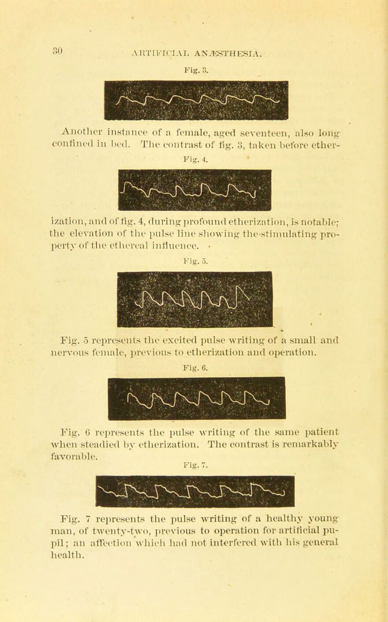 Another instance of a female, aged seventeen, also long confined in bed. The contrast of fig. 3, taken before ether- Fig. 4. ization, and of fig. 4, during profound etherization, is notable; the elevation of the pulse line showing the-stimulating pro- perty of the ethereal influence. • Fig. o. Fig. 5 represents the excited pulse writing of a small and nervous female, previous to etherization and operation. Fig. 0. Fig. G represents the pulse writing of the same patient when steadied by etherization. The contrast is remarkably favorable. Fig. 7 represents the pulse writing of a healthy young man, of twenty-two, previous to operation for-artificialpu- pil; an affection which had not interfered with his general health.