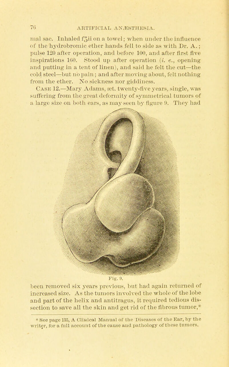 mal sac. Inhaled f5ii on a towel; when under the influence of the hydrobromic ether hands fell to side as with Dr. A.; pulse 120 after operation, and before 100, and after first five inspirations 160. Stood up after operation (i. e., opening and putting in a tent of linen), and said he felt the cut—the eold steel—but no pain; and after moving about, felt nothing from the ether. No sickness nor giddiness. Case 12.—Mary Adams, set. twenty-five years, single, was suffering from the great deformity of symmetrical tumors of a large size on both ears, as may seen by figure 9. They had V Fig. 9, been removed six years previous, but had again returned of increased size. As the tumors involved the whole of the lobe and part of the helix and antitragus, it required tedious dis- section to save all the skin and get rid of the fibrous tumor,* * See page 135, A Clinical Manual of the Diseases of the Ear, by the writer, for a full account of the cause ami pathology of these tumors.