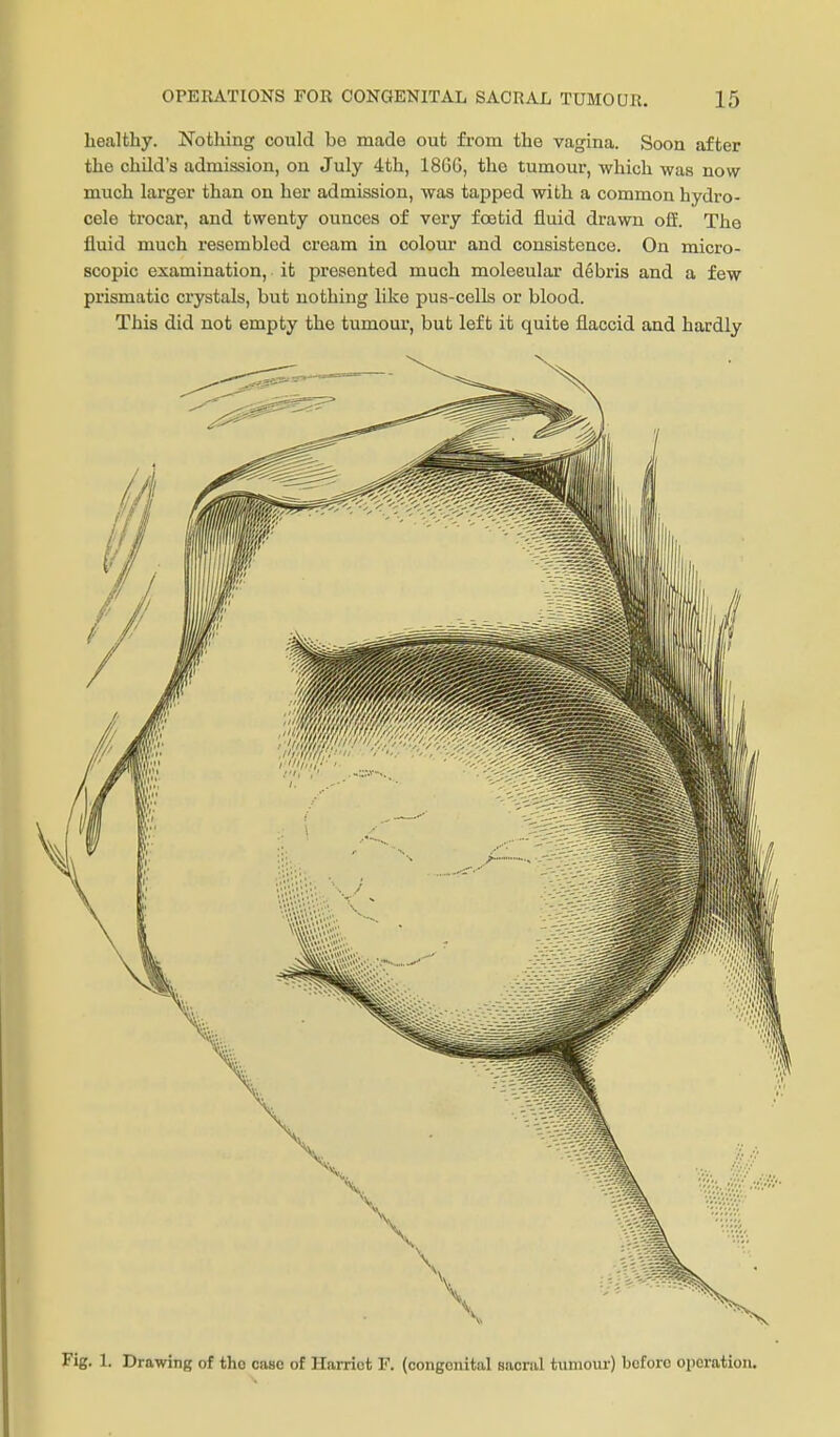 healthy. Nothing could be made out from the vagina. Soon after the child's admission, on July 4th, 1866, the tumour, which was now much larger than on her admission, was tapped with a common hydro- cele trocar, and twenty ounces of very foetid fluid drawn off. The fluid much resembled cream in colour and consistence. On micro- scopic examination, it presented much molecular debris and a few prismatic crystals, but nothing like pus-cells or blood. This did not empty the tumour, but left it quite flaccid and hardly Fig. 1. Drawing of tho case of Harriot F. (congenital sacriil tunioiu-) before operation.