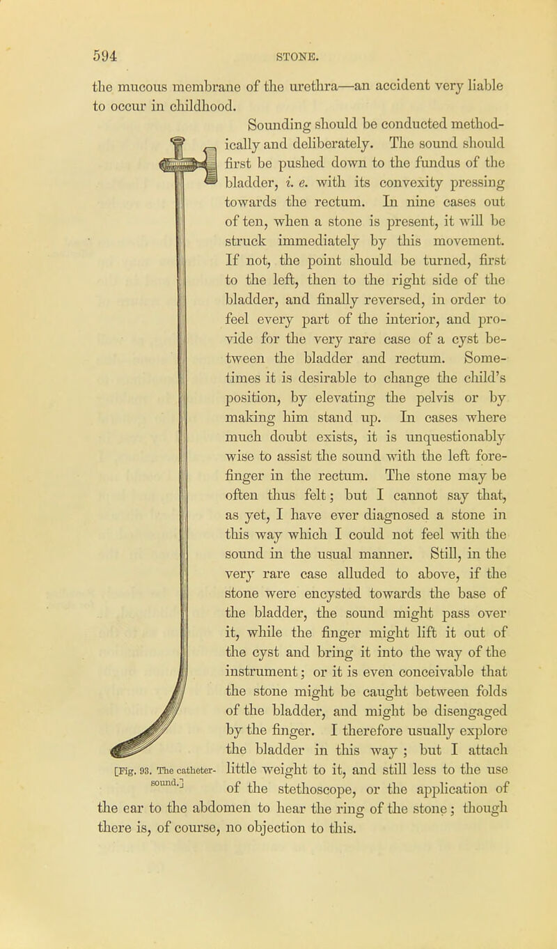 the mucous membrane of the urethra—an accident very liable to occur in childhood. Sounding should be conducted method- ically and deliberately. The sound should first be pushed down to the fundus of the bladder, i. e. with its convexity pressing towards the rectum. In nine cases out of ten, when a stone is present, it will be struck immediately by this movement. If not, the point should be turned, first to the left, then to the right side of the bladder, and finally reversed, in order to feel every part of the interior, and pro- vide for the very rare case of a cyst be- tween the bladder and rectum. Some- times it is desirable to change the child's position, by elevating the pelvis or by making him stand up. In cases where much doubt exists, it is unquestionably wise to assist the sound with the left fore- finger in the rectum. The stone may be often thus felt; but I cannot say that, as yet, I have ever diagnosed a stone in this way which I could not feel with the sound in the usual mamier. StiU, in the very rare case alluded to above, if the stone were encysted towards the base of the bladder, the sound might pass over it, while the finger might lift it out of the cyst and bring it into the way of the instrument; or it is even conceivable that the stone might be caught between folds of the bladder, and might be disengaged by the finger. I therefore usually explore the bladder in tliis way ; but I attacli little weight to it, and still less to the use of the stethoscope, or the application of the ear to the abdomen to hear the ring of the stone; though there is, of course, no objection to this. [Pig, 93. The catheter- Bound.]