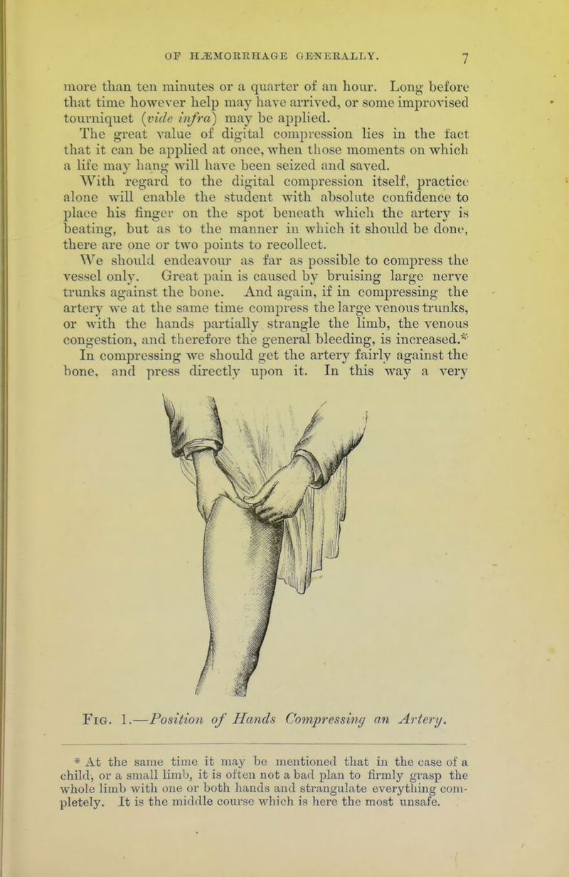 more than ten minutes or a quarter of an hour. Long before that time however help may have arrived, or some improvised tourniquet (vide infra) may be applied. The great value of digital compression lies in the fact that it can be applied at once, when those moments on which a life may hang will have been seized and saved. With regard to the digital compression itself, practice alone will enable the student with absolute confidence to place his finger on the spot beneath which the artery is beating, but as to the manner in which it should be done, there are one or two points to recollect. We should endeavour as far as possible to compress the vessel only. Gi-eat pain is caused by bruising large nerve trunks against the bone. And again, if in compressing the artery we at the same time compress the large venous trunks, or with the hands partially strangle the limb, the venous congestion, and therefore the general bleeding, is increased.* In compressing we should get the artery fairly against the bone, and press directly upon it. In this way a very Fig. 1.—Position of Hands Compressing an Artery. * At the same time it may be mentioned that in the case of a child, or a small limb, it is often not a bad plan to firmly grasp the whole limb with one or both hands and strangulate everything com- pletely. It is the middle course which is here the most unsafe.