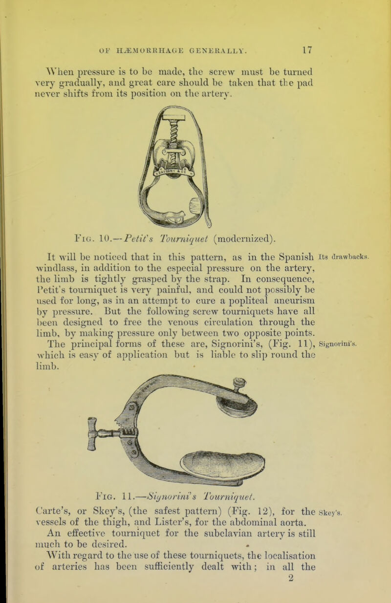 When pressure is to be made, the screw must be turned very gradually, and great care should be taken that the pad never shifts from its position on the artery. Fig. 10. — Petit's Tourniquet (modernized). It will be noticed that in this pattern, as in the Spanish its drawbacks, windlass, in addition to the especial pressure on the artery, the limb is tightly grasped by the strap. In consequence, Petit's tourniquet is very painful, and could not possibly be used for long, as in an attempt to cure a popliteal aneurism by pressure. But the following screw tourniquets have all been designed to free the venous circulation through the limb, by making pressure only between two opposite points. The principal forms of these are, Signorini's, (Fig. 11), Signovmis. which is easy of application but is liable to slip round the limb. Fig. 11.—Siynorini's Tourniquet. Carte's, or Skey's, (the safest pattern) (Fig. 12), for the Skey'i vessels of the thigh, and Lister's, for the abdominal aorta. An effective tourniquet for the subclavian artery is still much to be desired. « With regard to the use of these tourniquets, the localisation of arteries has been sufficiently dealt with; in all the 2