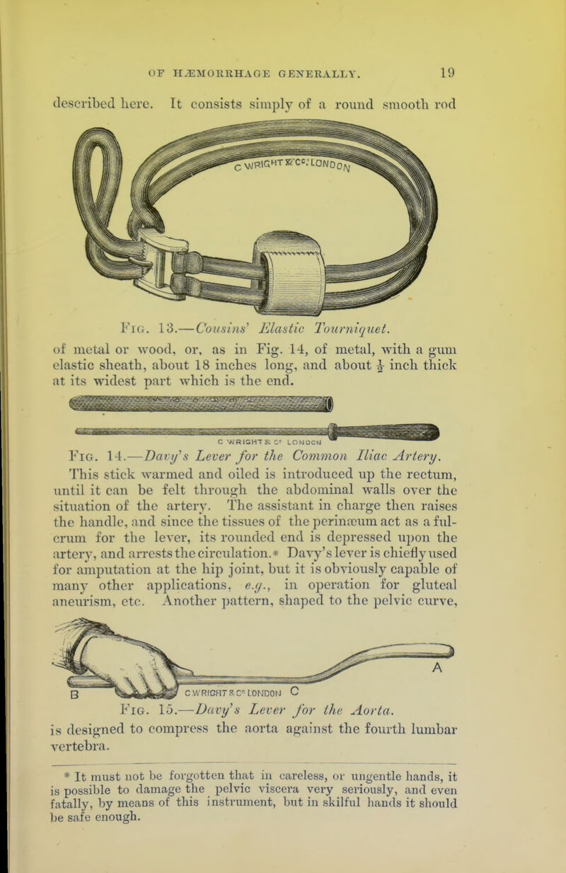 described here. It consists simply of a round smooth rod FlG. 13.—Cousins' Elastic Tourniquet. of metal or wood, or, as in Fig. 14, of metal, with a gum elastic sheath, about 18 inches long, and about h inch thick at its widest part which is the end. Fig. 14.—Davy's Lever for the Common Iliac Artery. This stick warmed and oiled is introduced up the rectum, until it can be felt through the abdominal walls over the situation of the artery. The assistant, in charge then raises the handle, and since the tissues of the pcrinamm act as a ful- crum for the lever, its rounded end is depressed upon the artery, and arrests the circulation. * Davy's lever is chiefly used for amputation at the hip joint, but it is obviously capable of many other applications, e.g., in operation for gluteal aneurism, etc. Another pattern, shaped to the pelvic curve, C WRIGHTRCr-LONDON C Fig. \o.—Davys Lever for the Aorta. is designed to compress the aorta against the fourth lumbar vertebra. * It must not be forgotten that in careless, or ungentle hands, it is possible to damage the pelvic viscera very seriously, and even fatally, by means of this instrument, but in skilful bands it should be safe enough.