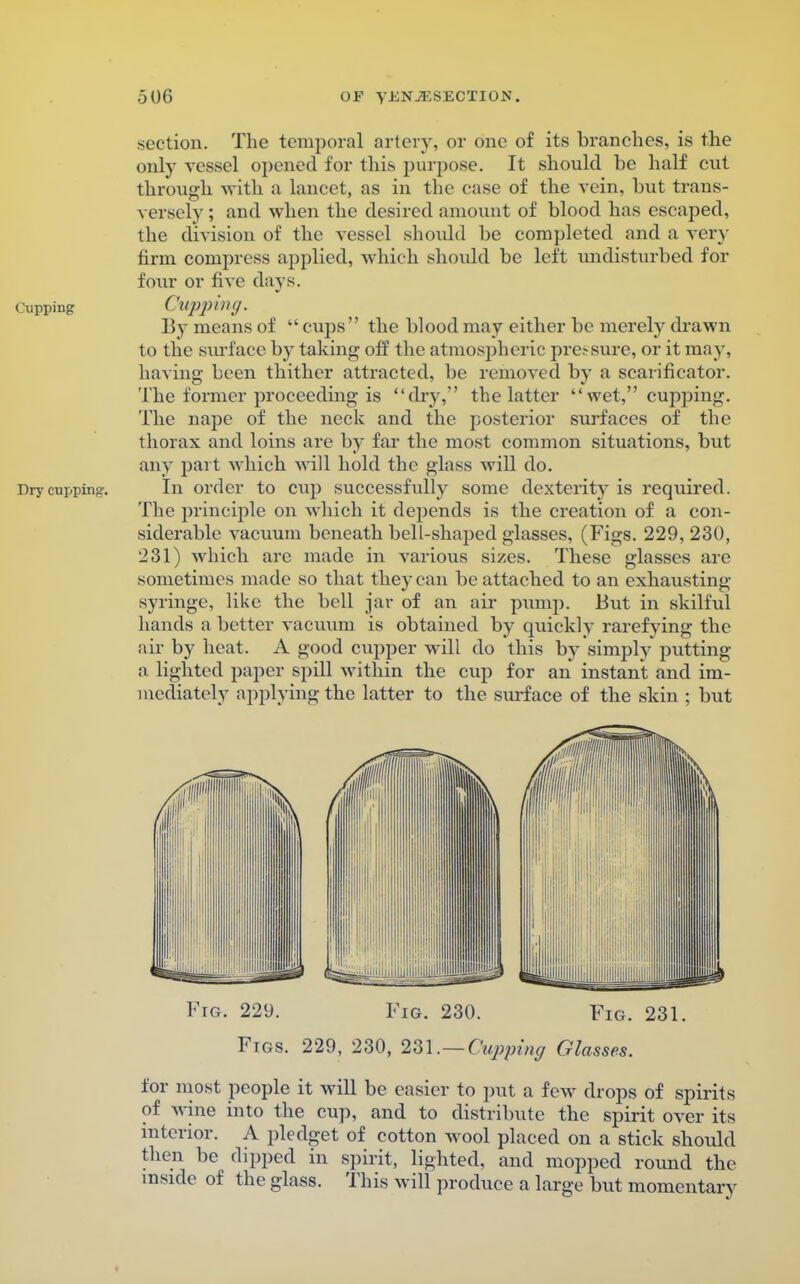section. The temporal artery, or one of its branches, is the only vessel opened for this purpose. It should be half cut through with a lancet, as in the case of the vein, but trans- versely ; and when the desired amount of blood has escaped, the division of the vessel shoidd be completed and a very firm compress applied, which should be left undisturbed for four or five days. ('uppiiig. By means of  cups the blood may either be merely drawn to the surface by taking off the atmospheric pressure, or it may, having been thither attracted, be removed by a scarificator. The former proceeding is dry,' the latter  wet, cupping. The nape of the neck and the posterior surfaces of the thorax and loins are by far the most common situations, but any part which will hold the glass will do. In order to cup successfully some dexterity is required. The principle on which it depends is the creation of a con- siderable vacuum beneath bell-shaped glasses, (Figs. 229, 230, 231) which are made in various sizes. These glasses are sometimes made so that they can be attached to an exhausting syringe, like the bell jar of an air pump. But in skilful hands a better vacuum is obtained by quickly rarefying the air by heat. A good cupper will do this by simply putting a lighted paper spill within the cup for an instant and im- mediately applying the latter to the surface of the skin ; but Fig. 229. Fig. 230. Fig. 231. Figs. 229, 230, 231.—Cupping Glasses. for most people it will be easier to put a few drops of spirits of wine into the cup, and to distribute the spirit over its interior. A pledget of cotton wool placed on a stick should then be dipped in spirit, lighted, and mopped round the mside of the glass. This will produce a large but momentary