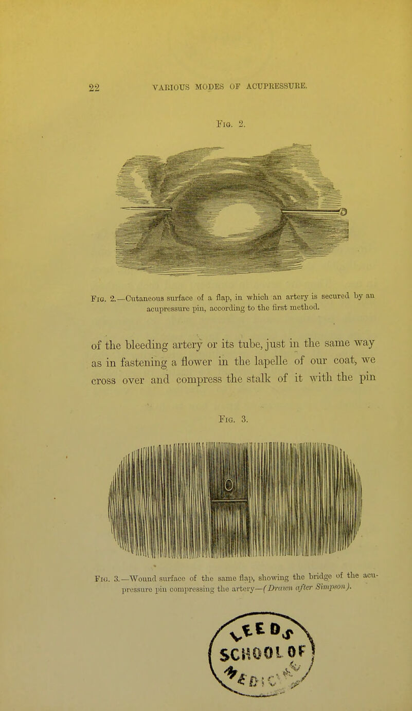 Via. 2. Fig. 2.—Cutaneous surface of a flap, in whicli an arteiy is secured hy an acupressure pin, according to the first method. of the bleeding artery or its tube, just in tlie same way as in fastening a flower in the lapelle of our coat, we cross over and compress the stalk of it with the pm riG. 3.