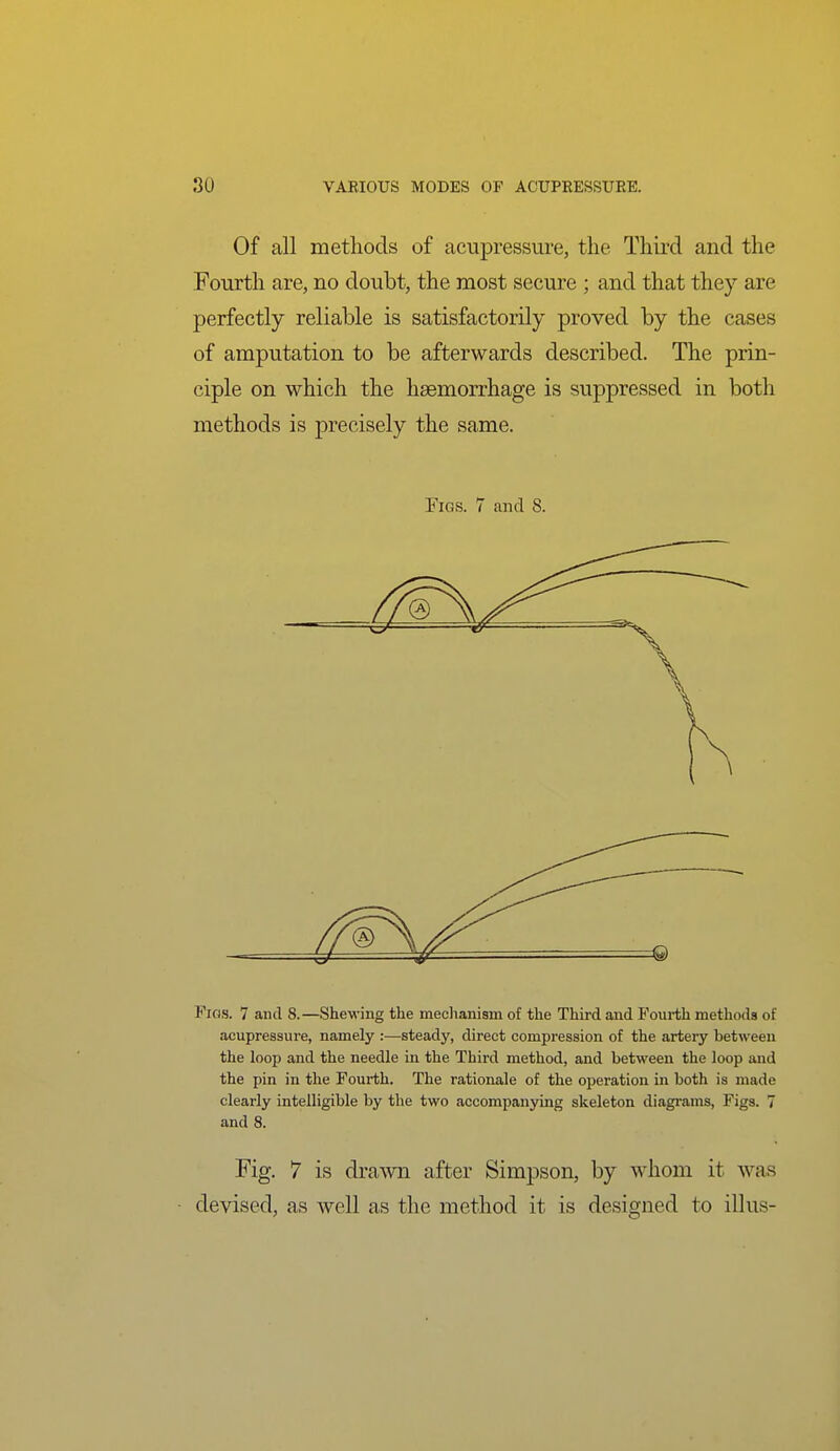 ! 80 VAEIOUS MODES OF ACUPRESSURE. Of all metliocis of acupressure, the Third and the Fourth are, no doubt, the most secure ; and that they are perfectly reliable is satisfactorily proved by the cases of amputation to be afterwards described. The prin- ciple on which the haemorrhage is suppressed in both methods is precisely the same. Pigs. 7 and 8. Fios. 7 and 8.—Shewing the meclianism of the Third and Fourth methods of acupressure, namely :—steady, direct compression of the artery between the loop and the needle in the Third method, and between the loop and the pin in the Fourth. The rationale of the operation in both is made clearly intelligible by the two accompanying skeleton diagrams, Figs. 7 and 8. Fig. 7 is drawn after Simpson, by whom it was • devised, as well as the method it is designed to illus- I