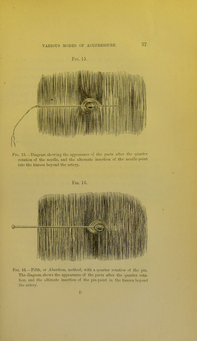 Fio. 15. Y\Cr. 15.—Diagram showing the appearance nf the parts after the quarter rotation of the needle, and the alternate insertion of the needle-point into the tissues beyond the artery. Fig. 16. Fro. IG.—Fifth, or Aberdeen, method, with a quarter rotation of the pin. The diagram shows tlic appearance of the parts after the quarter rota- tion, and the ultimate insertion of the jiin-point in tlic tissues beyond the artery. E
