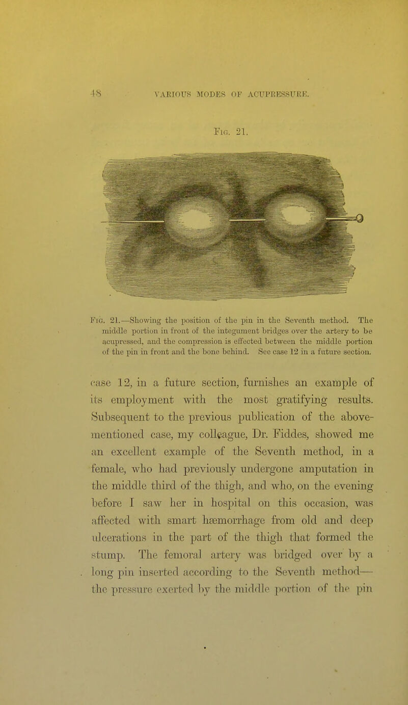 Fig. 21. Fig. 21.—Sliowing the position of the pin in the Seventh method. The middle i)ortion in front of the integument biidges over the artery to be £).cupressed, and the compression is effected between the middle portion of the pin in front and the bone behind. See case 12 in a future section. case 12, in a future section, furnishes an example of its employment with the most gratifying results. Subsequent to the previous publication of the above- mentioned case, my colleague. Dr. Fiddes, showed me an excellent example of the Seventh method, in a female, who had previously undergone amputation in the middle third of the thigh, and who, on the evening before I saw her in hospital on this occasion, was affected with smart haemorrhage from old and deep iJcerations in the part of the thigh that formed the stump. The femoral artery was bridged over by a long pin inserted according to the Seventh method— the pressure exerted by the middle portion of the pin