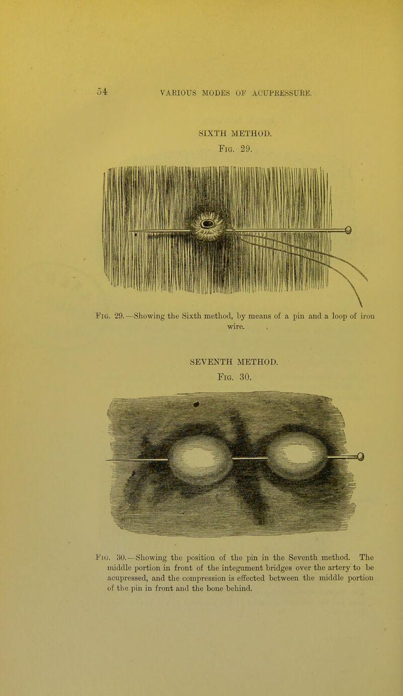 SIXTH METHOD. Fig. 29. Fig. 29.—Showing the Sixth method, by means of a pin and a loop of iron wire. SEVENTH METHOD. Fig. 30. Viit. 30.—Showing the i)osition of the pin in the Seventh method. The middle portion in front of the integument bridges over the artery to be acupressed, and the compression is effected between the middle portion of the pin in front and the bone behind.