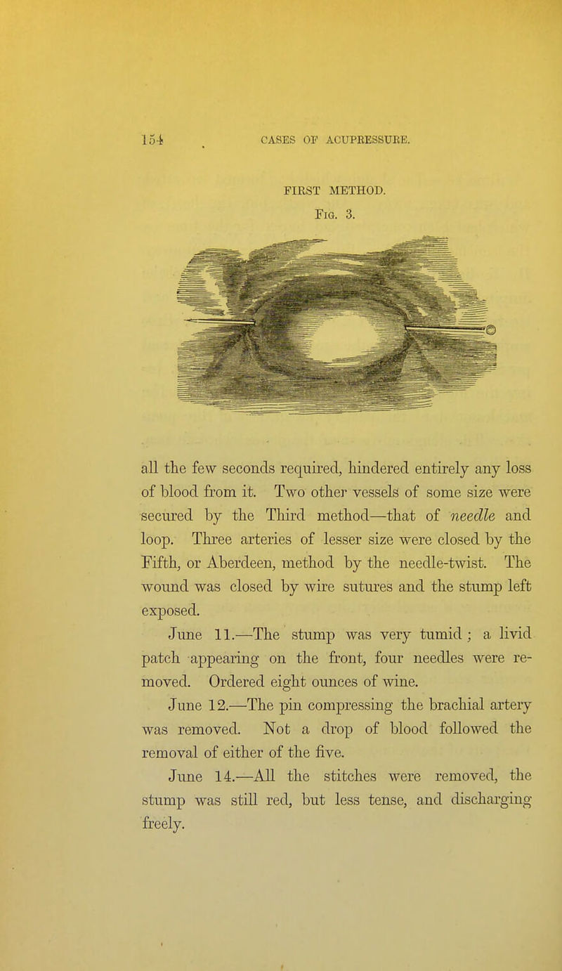 15-t , CASES or ACUPRESSURE. FIRST METHOD. Fig. 3. all the few seconds required, hindered entirely any loss of blood from it. Two other vessels of some size were secured by the Third method—that of needle and loop. Three arteries of lesser size were closed by the Fifth, or Aberdeen, method by the needle-twist. The wound was closed by wire sutures and the stump left exposed. June 11.—The stump was very tumid; a livid patch appearing on the front, four needles were re- moved. Ordered eight ounces of wine. June 12.—The pin compressing the brachial artery was removed. Not a drop of blood followed the removal of either of the five. June 14.—All the stitches were removed, the stump was still red, but less tense, and discharging freely.