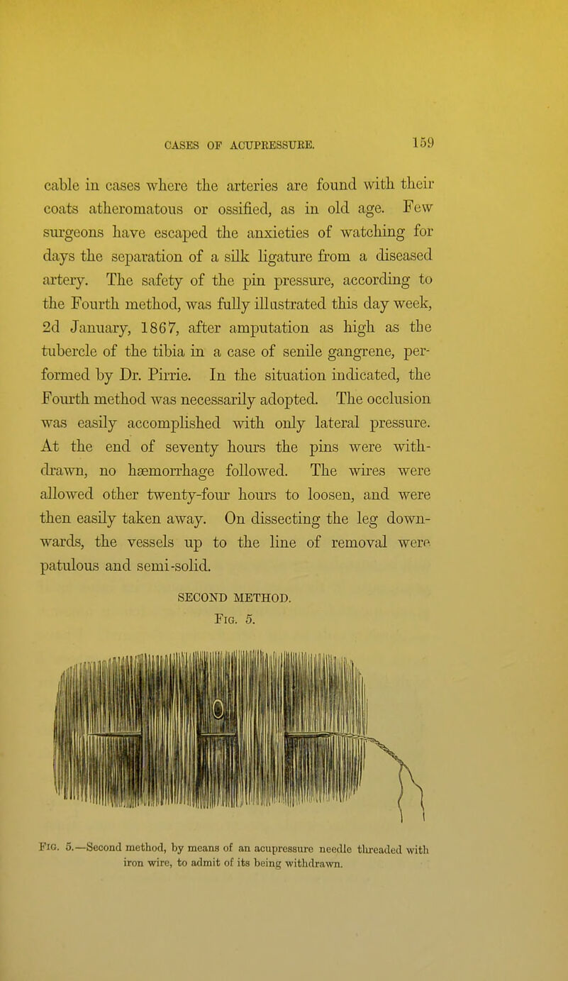 cable in cases where the arteries are found with their coats atheromatous or ossified, as in old age. Few sui-geons have escaped the anxieties of watching for days the separation of a silk ligature from a diseased artery. The safety of the pin pressure, according to the Fourth method, was fully illustrated this day week, 2d January, 1867, after amputation as high as the tubercle of the tibia in a case of senile gangrene, per- formed by Dr. Pirrie. In the situation indicated, the Fourth method was necessarily adopted. The occlusion was easily accomplished with only lateral pressure. At the end of seventy hours the pins were with- drawn, no haemorrhage followed. The wires were allowed other twenty-fom' hours to loosen, and were then easily taken away. On dissecting the leg down- wards, the vessels up to the line of removal were patulous and semi-solid. SECOND METHOD. Fig. 5. Fig. 5.—Second method, by means of an acupressure needle tlireaded with iron wire, to admit of its being withdrawn.