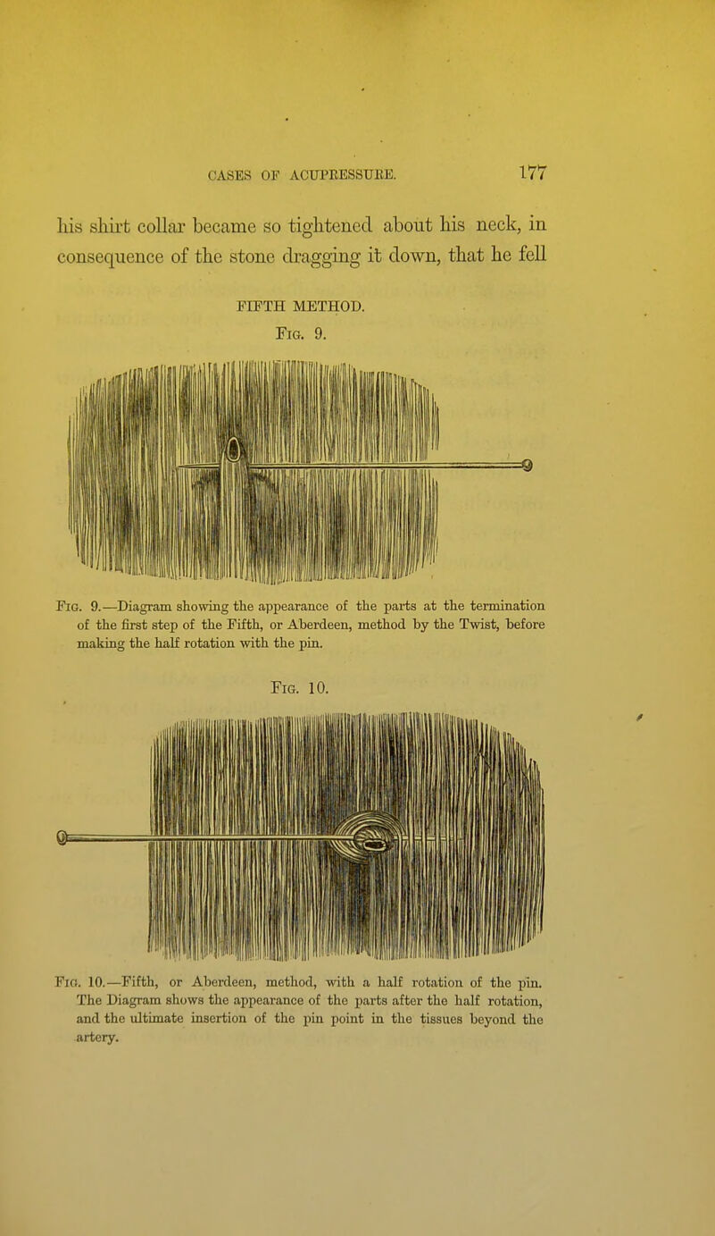 his shirt collar became so tightened about his neck, in consequence of the stone dragging it down, that he fell FIFTH METHOD. Fig. 9. Fig. 9.—Diagram showing the appearance of the parts at the termination of the first step of the Fifth, or Aberdeen, method by the Twist, before making the half rotation with the pin. Fig. 10. Fig. 10.—Fifth, or Aberdeen, method, with a half rotation of the pin. The Diagram shows the appearance of the jjarts after the half rotation, and the ultimate insertion of the pin point in the tissues beyond the artery.