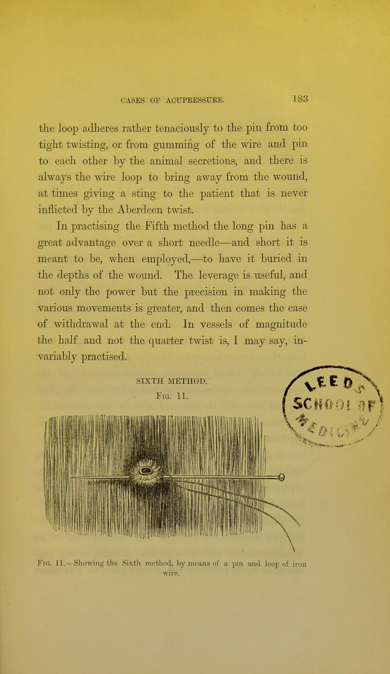 CASES OF ACUPEESSUEE. 183 the loop adlieres rather tenaciously to the pin from too tight twisting, or from gumming of the wire and pin to each other by the animal secretions, and there is always the wire loop to bring away from the wound, at times giving a sting to the patient that is never inflicted by the Aberdeen twist. In practising the Fifth method the long pin has a great advantage over a short needle—and short it is meant to be, when employed,—to have it buried in the depths of the wound. The leverage is useful, and not only the power but the precision in making the various movements is greater, and then comes the case of withdrawal at the end. In vessels of magnitude the half and not the quarter twist is, I may say, in- variably practised. Fu!. 11.—Showing the Sixth method, by means of a i)in and loop of iron ' wire. , i