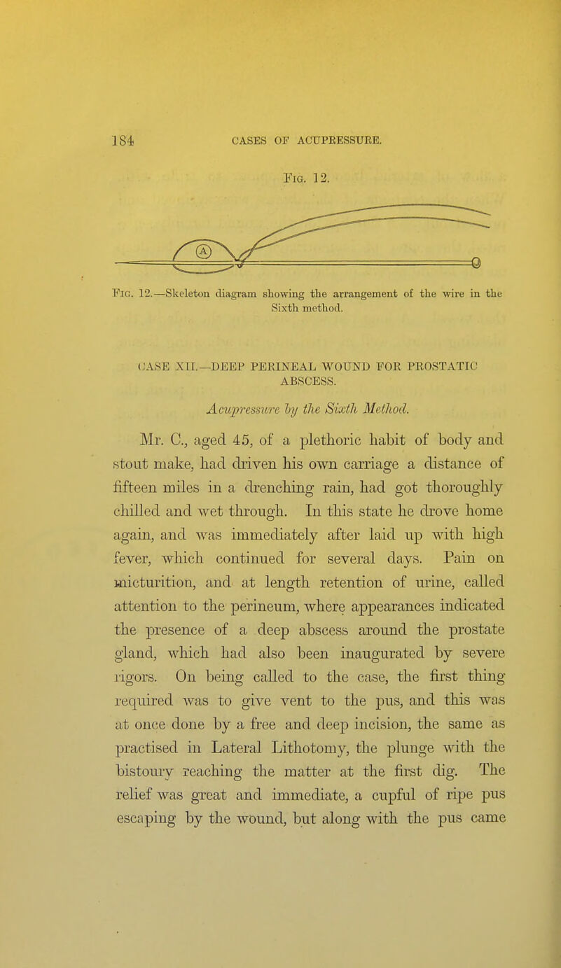 Fig. 12. Fig. 12.—Skeleton diagram showing the arrangement of the wire in the Sixth methocl. (JASE XII.—DEEP PERINEAL WOUND EOR PROSTATIC ABSCESS. Acicpressure ly the Sixth Methocl. Mr. C, aged 45, of a, plethoric habit of body and stout make, had driven his own carriage a distance of fifteen miles in a drenching rain, had got thoroughly chilled and wet through. In this state he drove home again, and was immediately after laid up with high fever, which continued for several days. Pain on micturition, and at length retention of urine, called attention to the perineum, where appearances indicated the presence of a deep abscess around the prostate gland, which had also been inaugurated by severe rigors. On being called to the case, the first thing required was to give vent to the pus, and this wa.s at once done by a free and deep incision, the same as practised in Lateral Lithotomy, the plunge with the bistomy reaching the matter at the first dig. The relief was great and immediate, a cupful of ripe pus escaping by the wound, but along with the pus came
