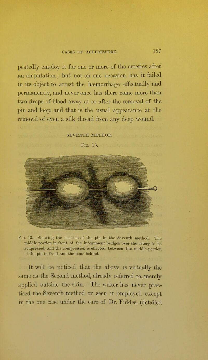 peatedly employ it for one or more of the arteries after an amputation; but not on one occasion has it failed in its object to arrest the haemorrhage effectually and permanently, and never once has there come more than two drops of blood away at or after the removal of the pin and loop, and that is the usual appearance at the removal of even a silk thread from any deep wound. SEVENTH METHOD. Fig. 13. Fio. 13.—Showing the position of the pin iu the Seventh method. The middle portion in front of the integument bridges over the artery to be acupressed, and the compression is effected between the middle portion of the pin in front and the bone behind. It will be noticed that the above is virtually the same as the Second method, already referred to, merely applied outside the skin. The writer has never prac- tised the Seventh method or seen it employed except in the one case under the care of Dr. Fiddes, (detailed