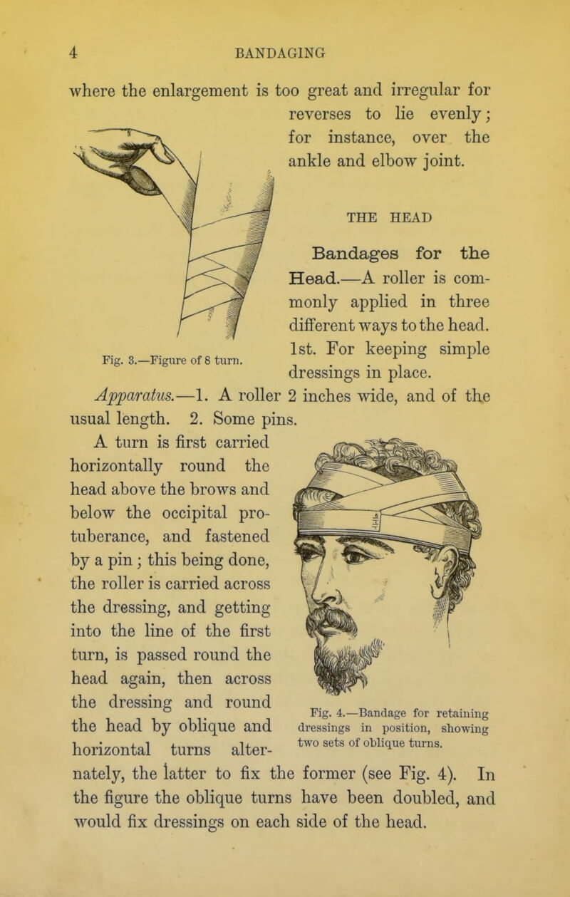 Fig. 3.—Figure of 8 turn. where the enlargement is too great and irregular for reverses to lie evenly; for instance, over the ankle and elbow joint. THE HEAD Bandages for the Head.—A roller is com- monly applied in three different ways to the head. 1st. For keeping simple dressings in place. Apparatus.—1. A roller 2 inches wide, and of th.e usual length. 2. Some pins. A turn is first carried horizontally round the head above the brows and below the occipital pro- tuberance, and fastened by a pin; this being done, the roller is carried across the dressing, and getting into the line of the first turn, is passed round the head again, then across the dressing and round the head by oblique and horizontal turns alter- nately, the latter to fix the former (see Fig. 4). In the figure the oblique turns have been doubled, and would fix dressings on each side of the head. Fig. 4.—Bandage for retaining dressings in position, showing two sets of oblique turns.