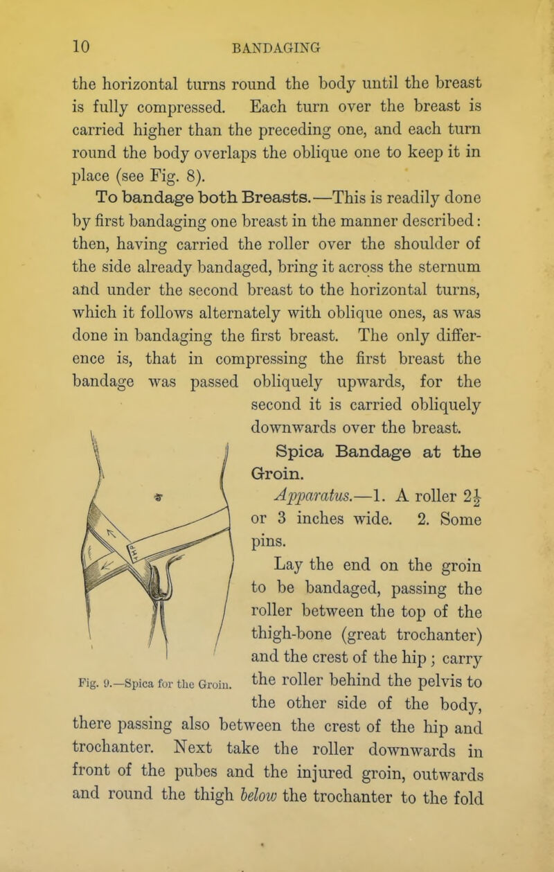 the horizontal turns round the body until the breast is fully compressed. Each turn over the breast is carried higher than the preceding one, and each turn round the body overlaps the oblique one to keep it in place (see Fig. 8). To bandage both Breasts.—This is readily done by first bandaging one breast in the manner described: then, having carried the roller over the shoulder of the side already bandaged, bring it across the sternum and under the second breast to the horizontal turns, which it follows alternately with oblique ones, as was done in bandaging the first breast. The only differ- ence is, that in compressing the first breast the bandage was passed obliquely upwards, for the second it is carried obliquely downwards over the breast. Spica Bandage at the Groin. Apparatus.—1. A roller 2| or 3 inches wide. 2. Some pins. Lay the end on the groin to be bandaged, passing the roller between the top of the thigh-bone (great trochanter) and the crest of the hip ; carry Fig. 9.—Spica for the Groin, ^^e roller behind the pelvis to the other side of the body, there passing also between the crest of the hip and trochanter. Next take the roller downwards in front of the pubes and the injured groin, outwards and round the thigh Mow the trochanter to the fold