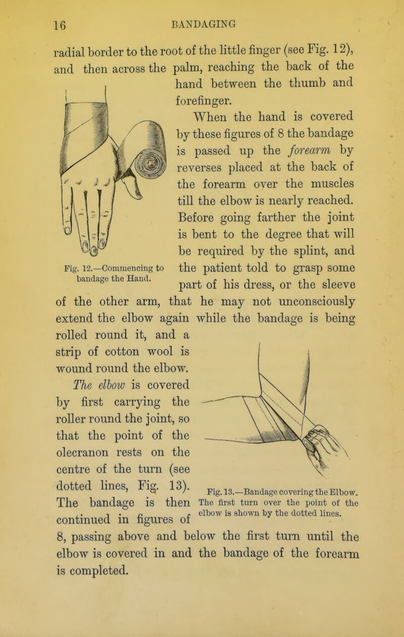 Fig. 12.—Commencing to bandage the Hand. radial border to the root of the httle finger (see Fig. 12), and then across the palm, reaching the back of the hand between the thumb and forefinger. When the hand is covered by these figures of 8 the bandage is passed up the forearm by- reverses placed at the back of the forearm over the muscles till the elbow is nearly reached. Before going farther the joint is bent to the degree that will be required by the splint, and the patient told to grasp some part of his dress, or the sleeve of the other arm, that he may not unconsciously extend the elbow again while the bandage is being rolled round it, and a strip of cotton wool is wound round the elbow. The elbow is covered by first carrying the roller round the joint, so that the point of the olecranon rests on the centre of the turn (see dotted lines. Fig. 13). The bandage is then continued in figures of 8, passing above and below the first turn until the elbow is covered in and the bandage of the forearm is completed. Fig. 13.—Bandage covering the Elbow. The first turn over the point of the elbow is shown by the dotted lines.